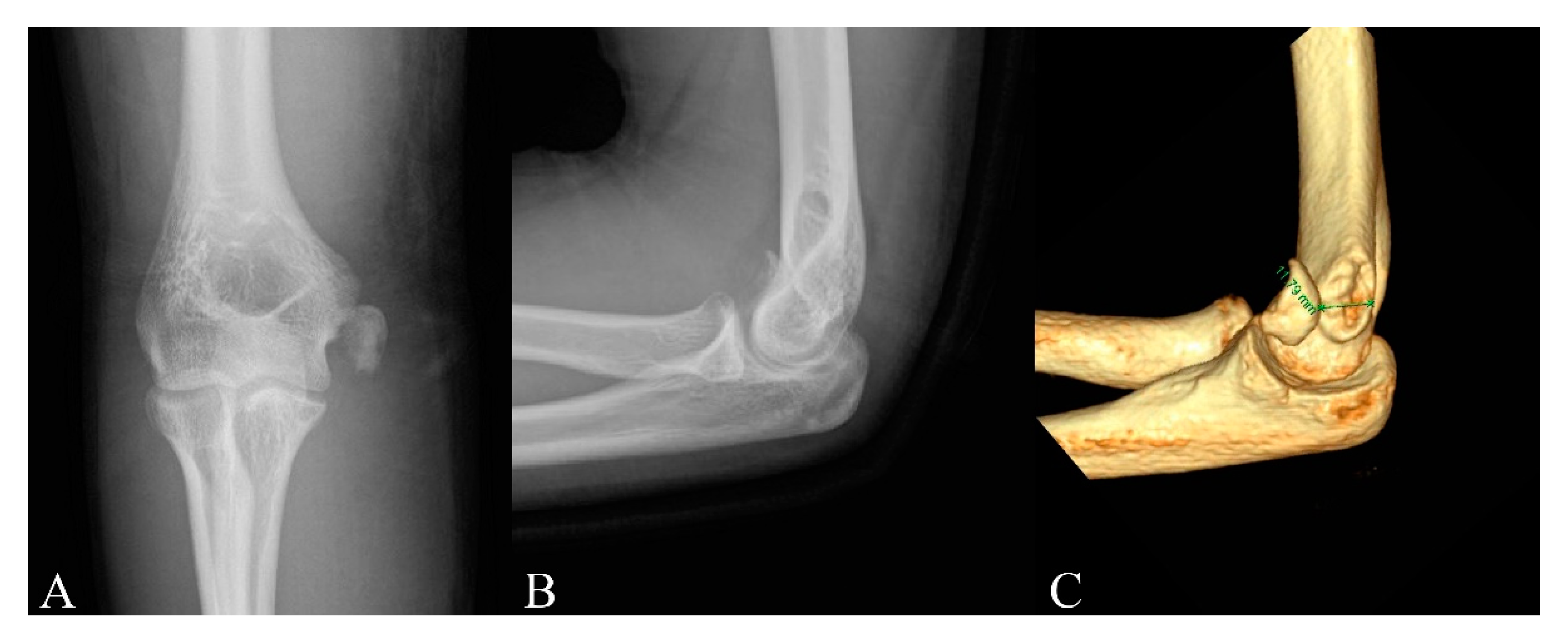 Diagnostics Free Full Text Is Computed Tomography Necessary For Diagnostic Workup In Displaced Pediatric Medial Epicondyle Fractures Html
