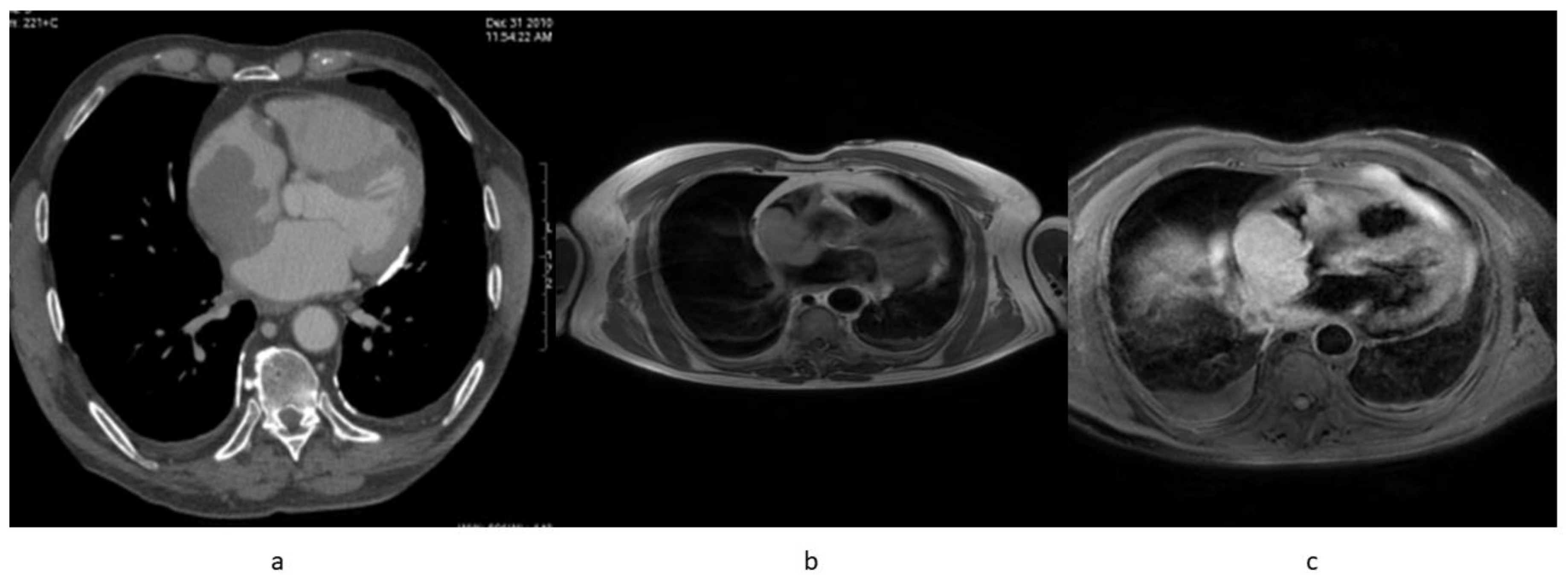 Diagnostics Free Full Text Right Atrium Mass Assessed With 18f Fdg Pet Ct Scan Turns Out To Be An Uncommon Relapse Of Testicular Diffuse Large B Cell Lymphoma A Case Report Html