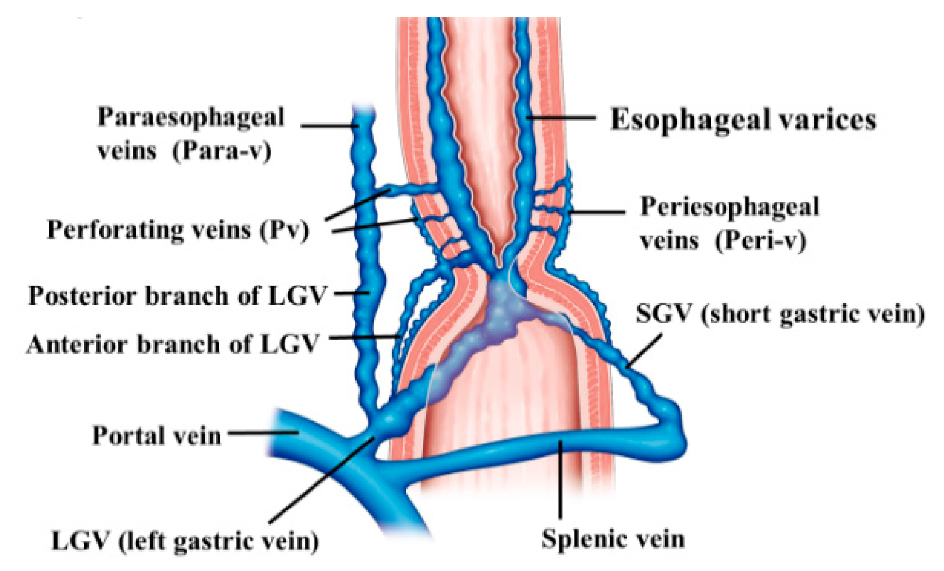 nursing case study esophageal varices