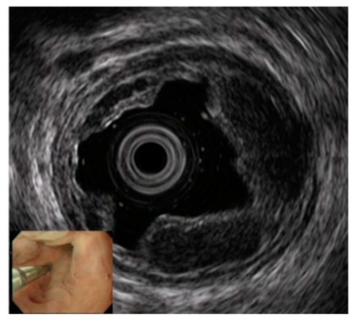 Diagnostics Free FullText The Role of Endoscopic Ultrasound for