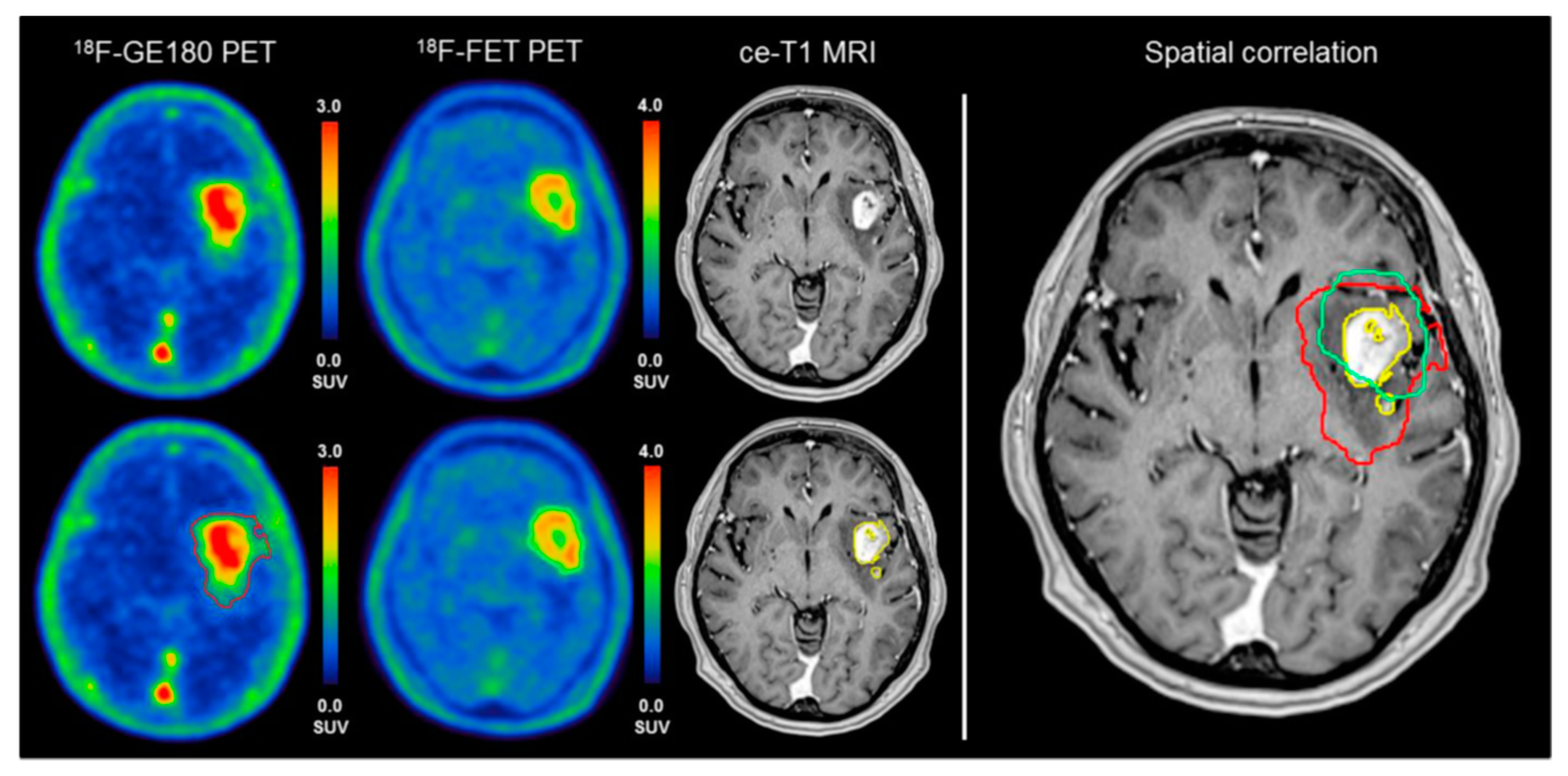 brain pet scan epilepsy