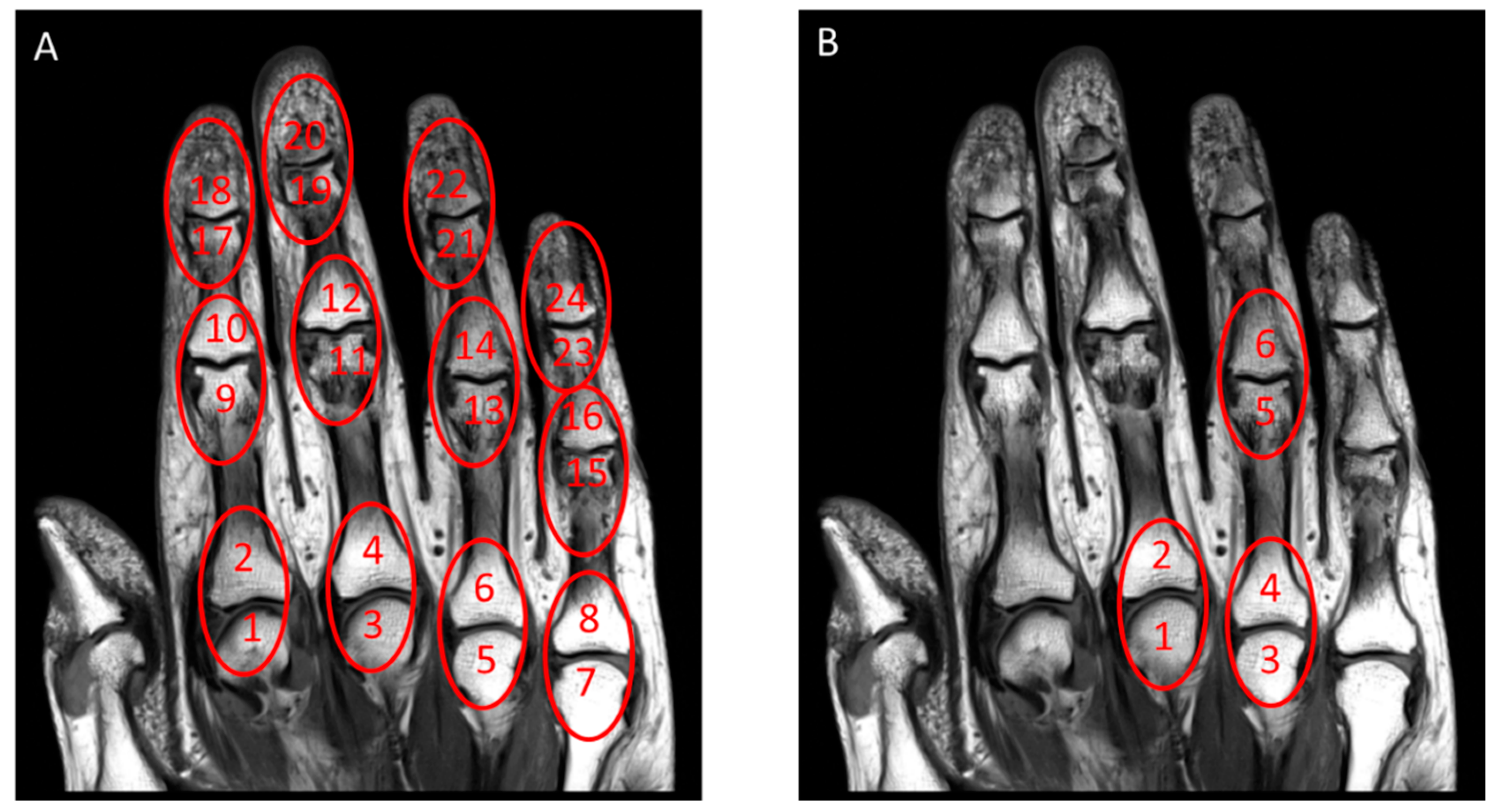 Psoriatic Arthritis Images, Bedside To Bench Defining The Immunopathogenesis Of Psoriatic Arthritis Nature Reviews Rheumatology - It tends to develop in people with psoriasis.