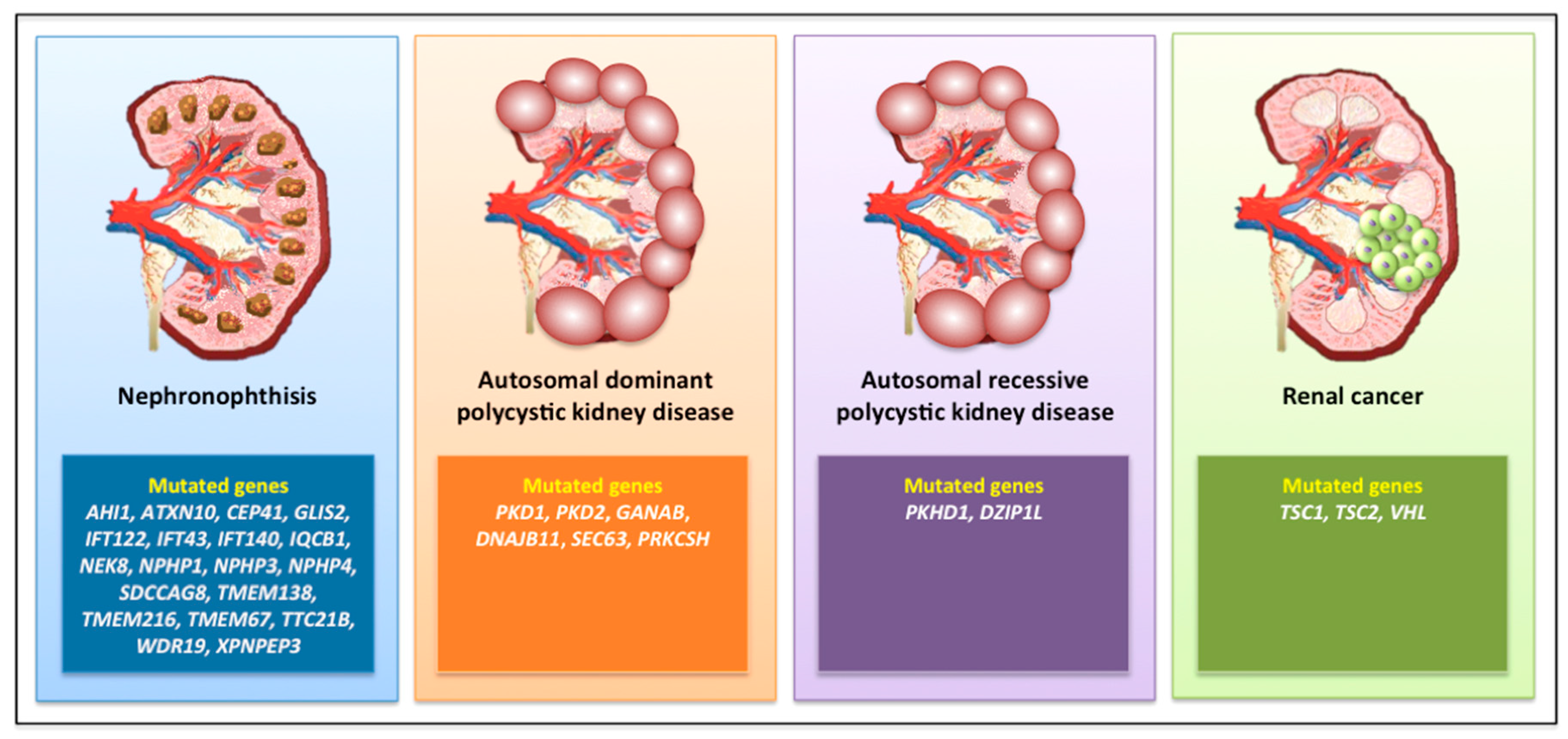 Exploring the Spectrum of Kidney Ciliopathies