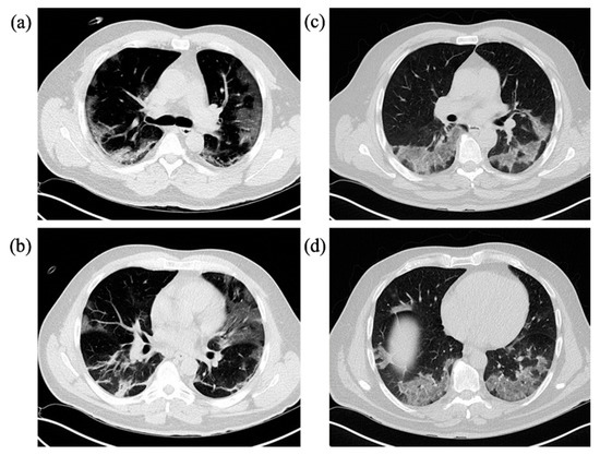 Prognostic Value of Admission Chest CT Findings for Invasive ...