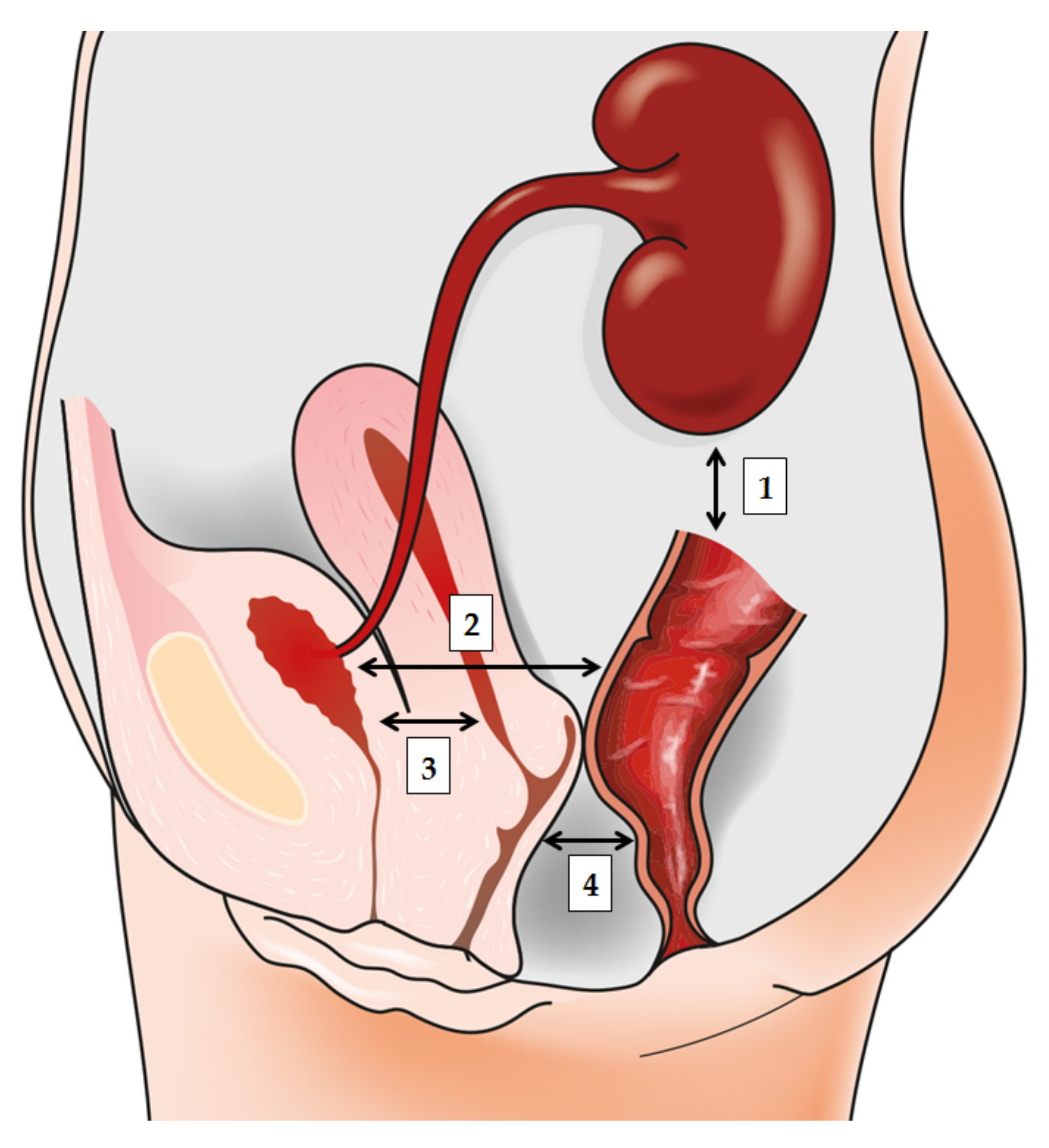 Prostatitis 1 és 2 fok. Adenoma hypophysis symptoms