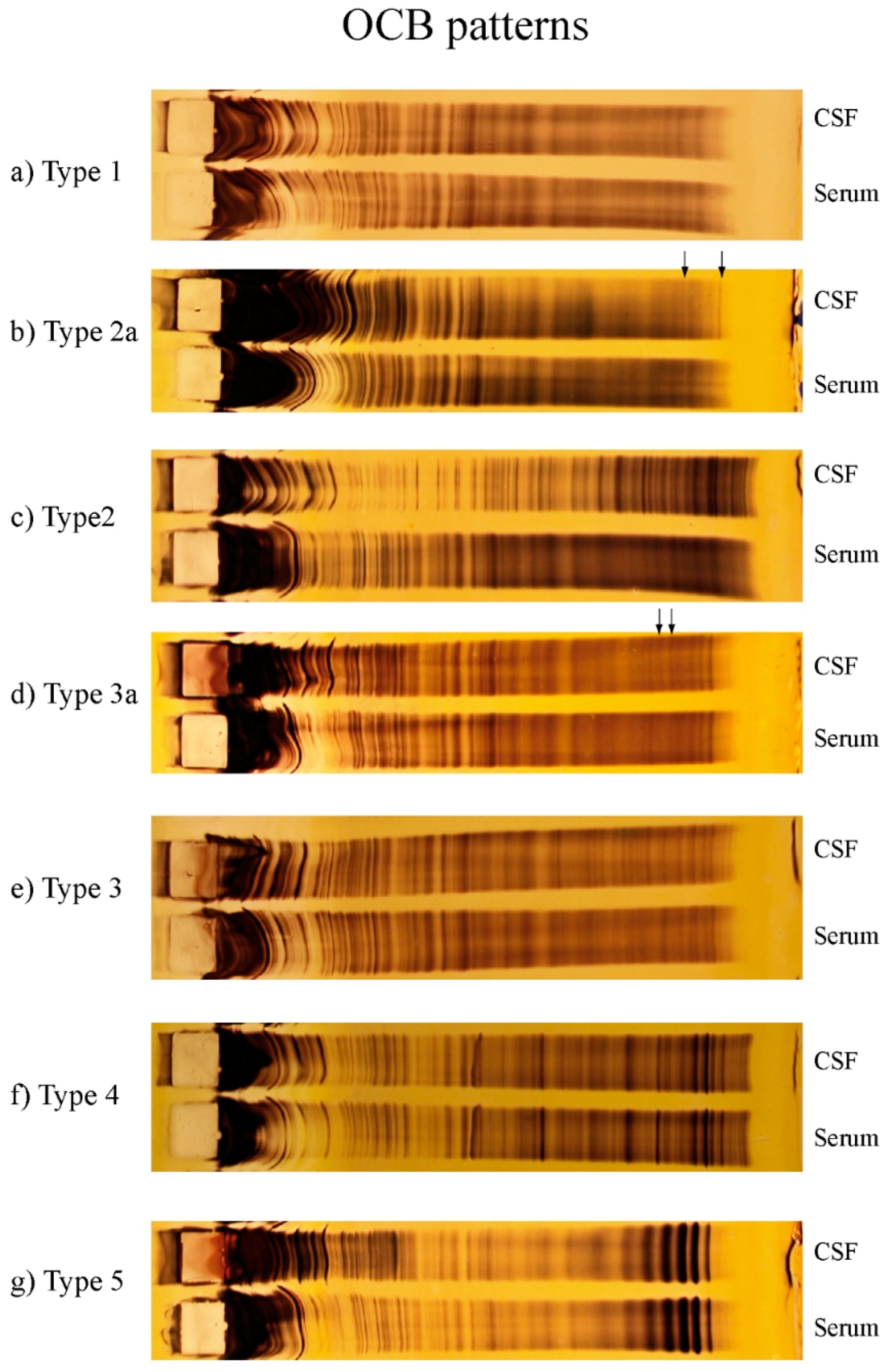 oligo bands csf positive and oligo bands serum 2 oligo bands csf positive and oligo bands serum 2