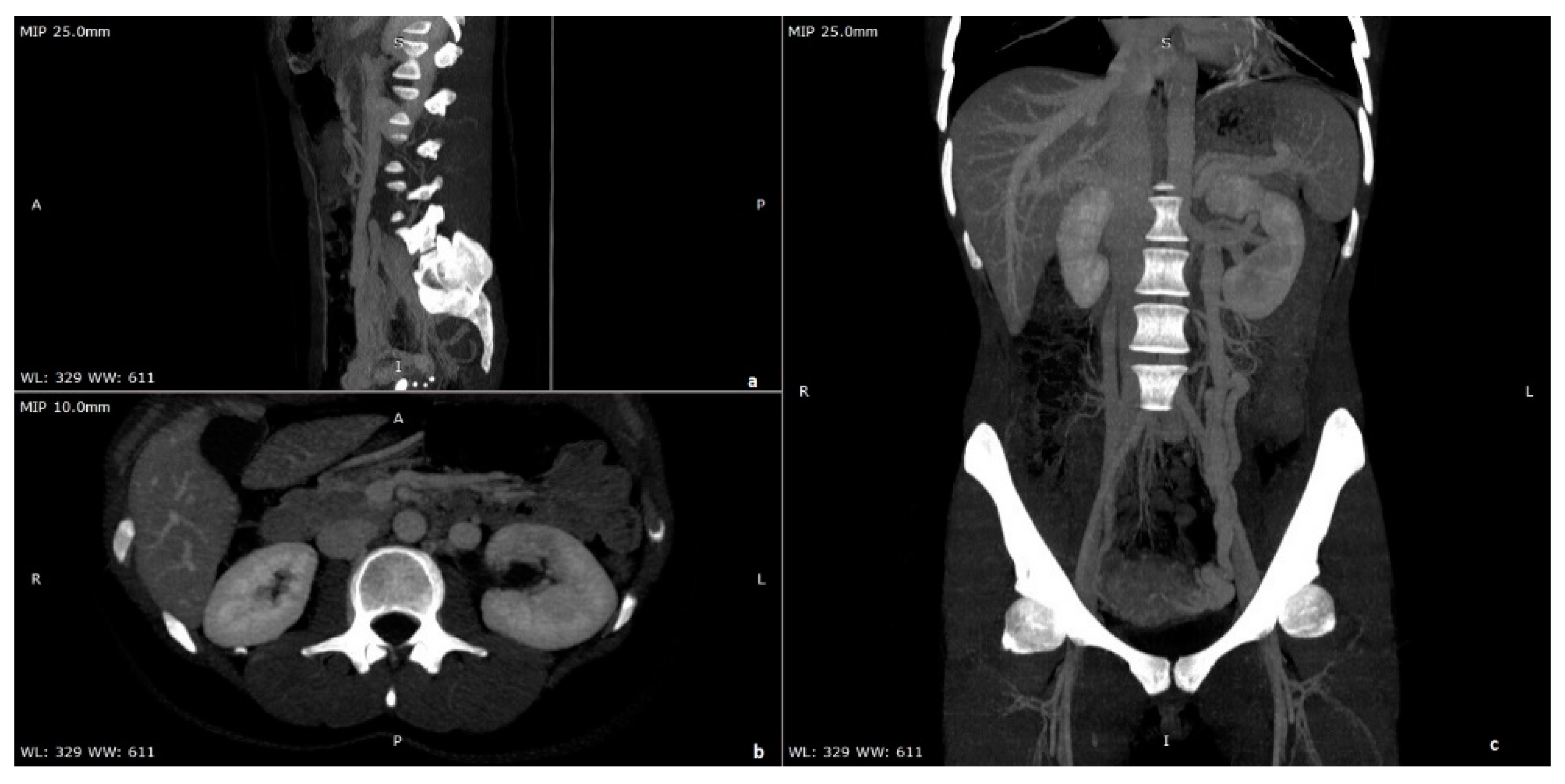 Diagnostics Free FullText From Nutcracker Phenomenon to Nutcracker
