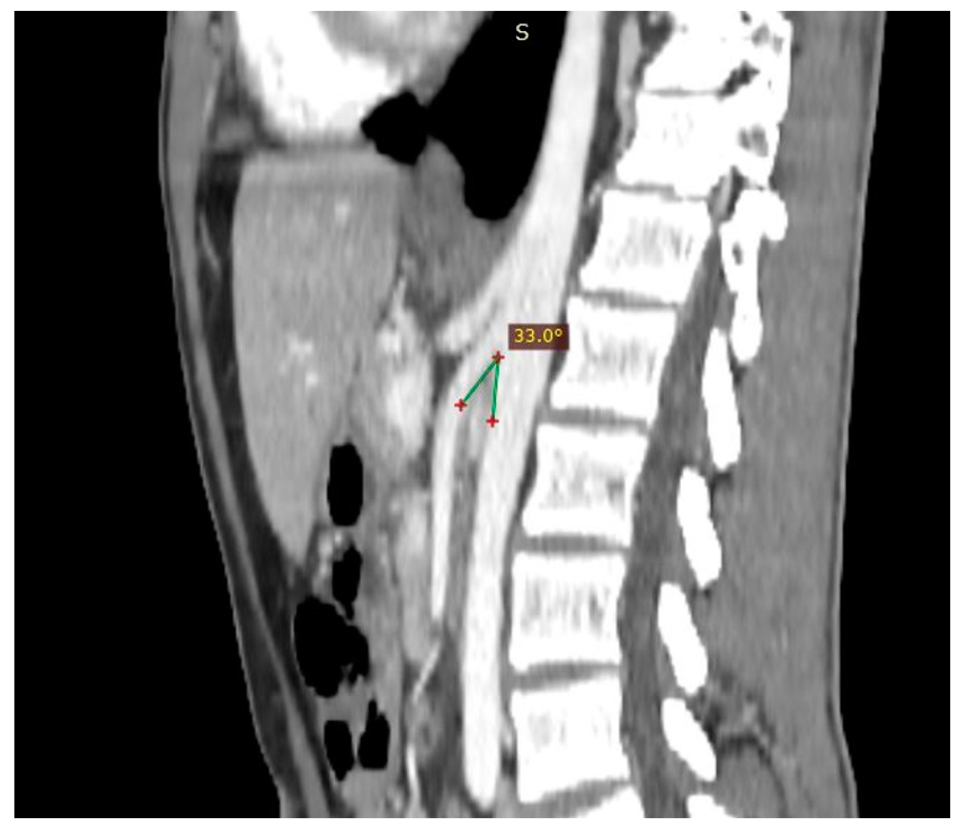 Diagnostics Free FullText From Nutcracker Phenomenon to Nutcracker