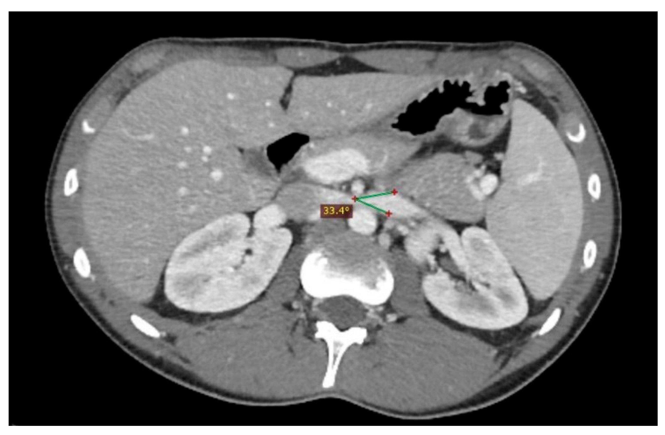 Nutcracker Syndrome Causes