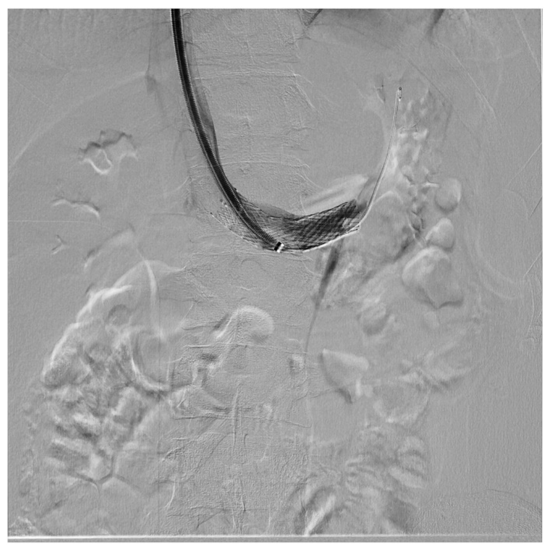 Diagnostics Free FullText From Nutcracker Phenomenon to Nutcracker