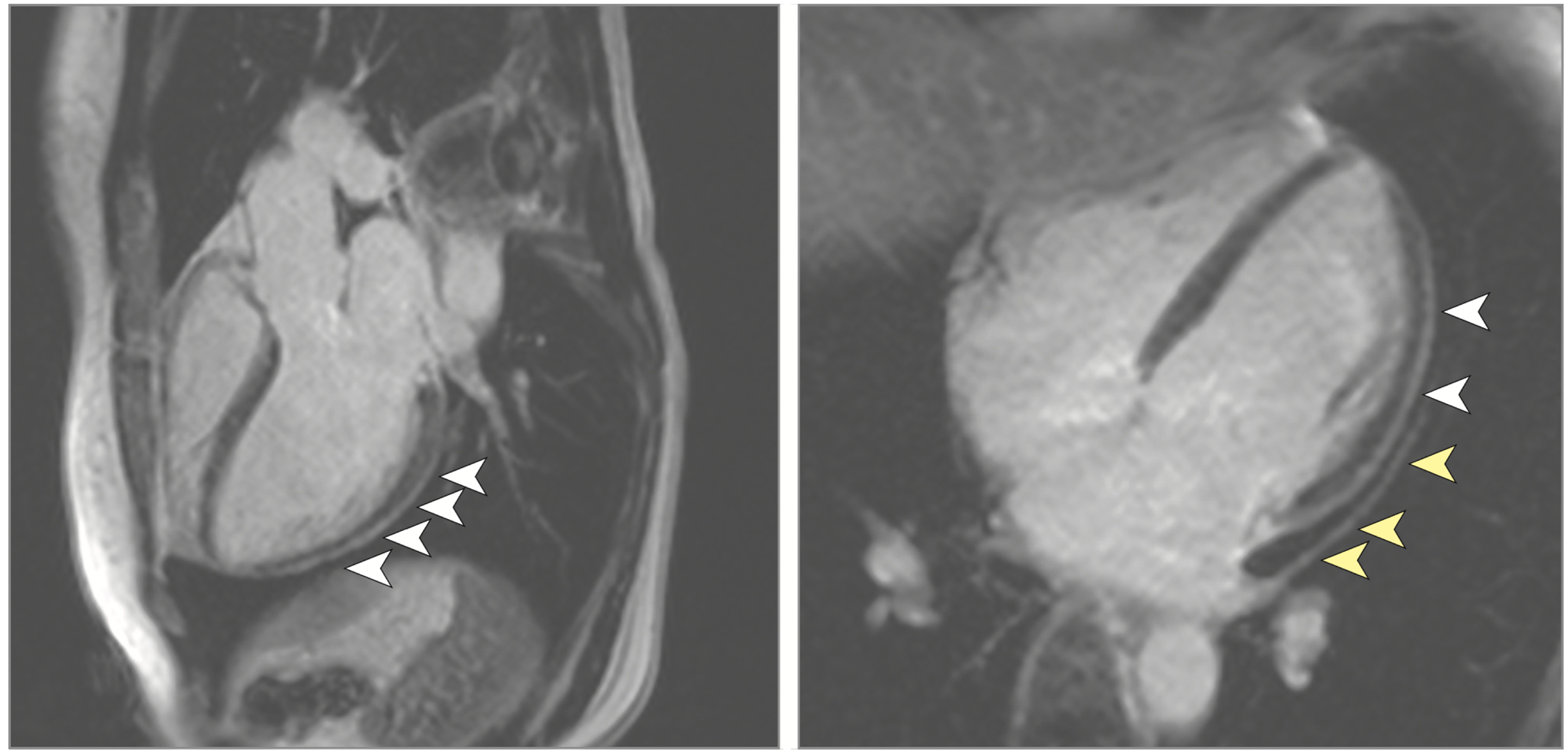 Diagnostics  Free Full-Text  Cardiac MRI and Myocardial Injury 