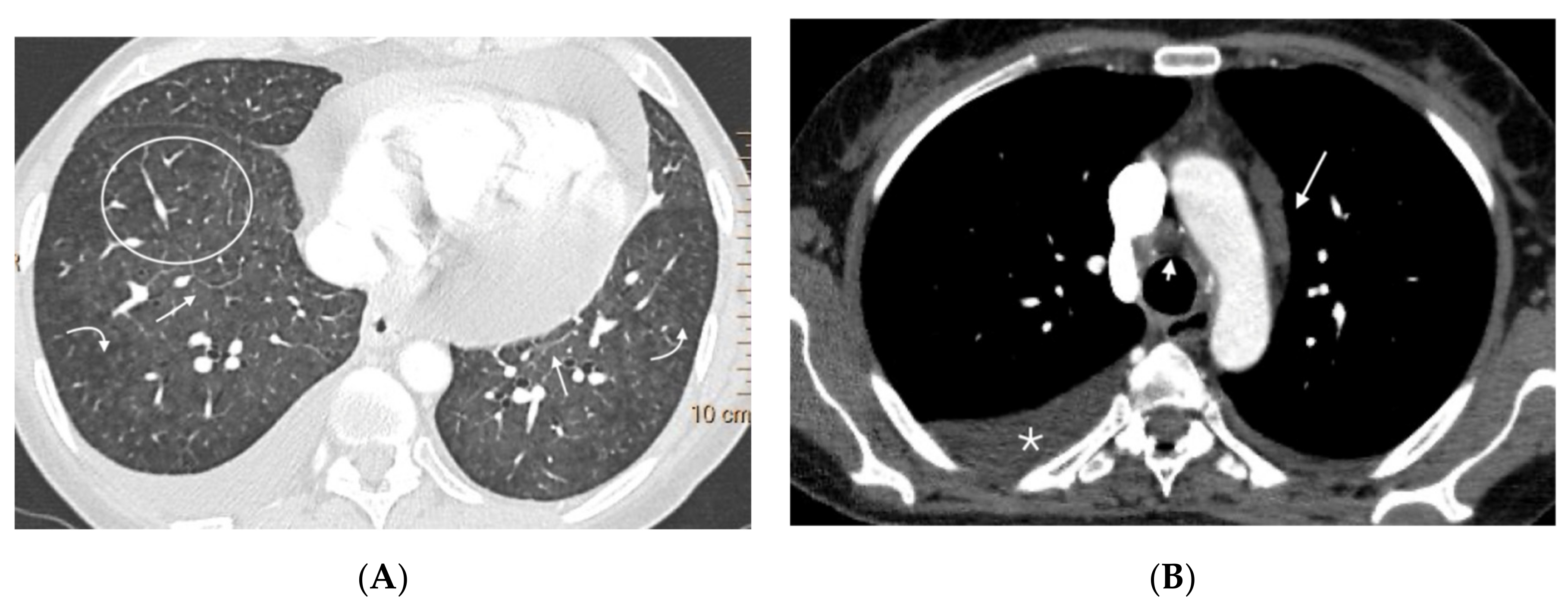Diagnostics Free Full-Text Radiological Findings in Multidetector Computed Tomography (MDCT) of Hereditary and Sporadic Pulmonary Veno-Occlusive Disease Certainties and Uncertainties
