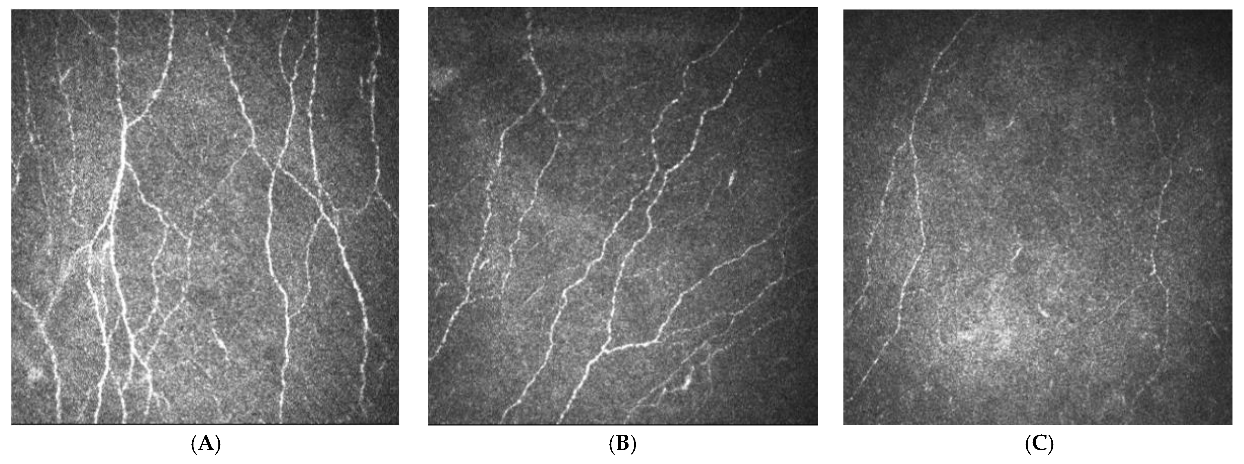 Biguanidek metformin. Biguanidok a diabetes mellitus kezelésében. Az SGLT2 inhibitorok származékai