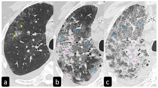 Chest Imaging of Patients with Sarcoidosis and SARS-CoV-2