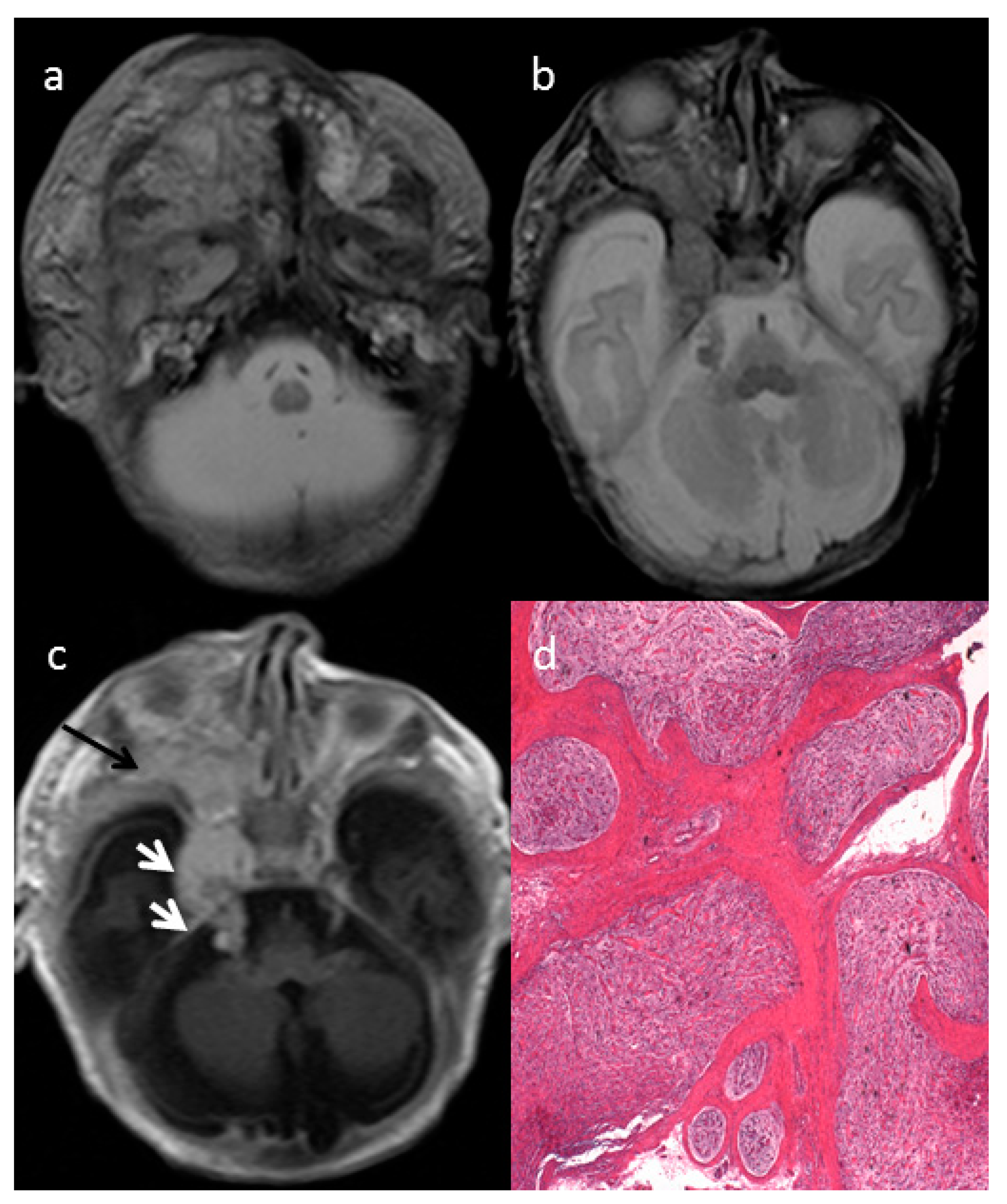 Diagnostics Free FullText Congenital Craniofacial Plexiform