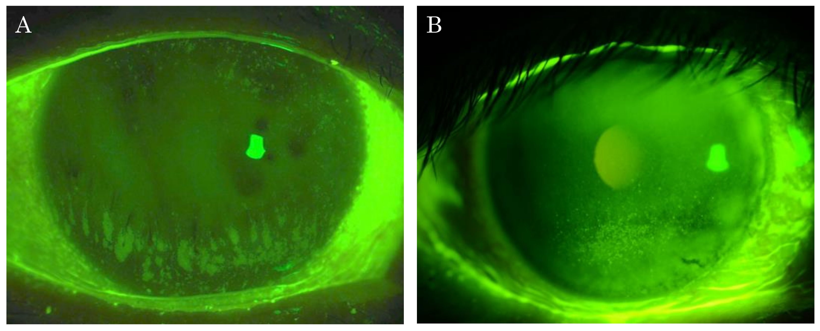 Mechanisms of superficial micropunctate corneal staining 51 off