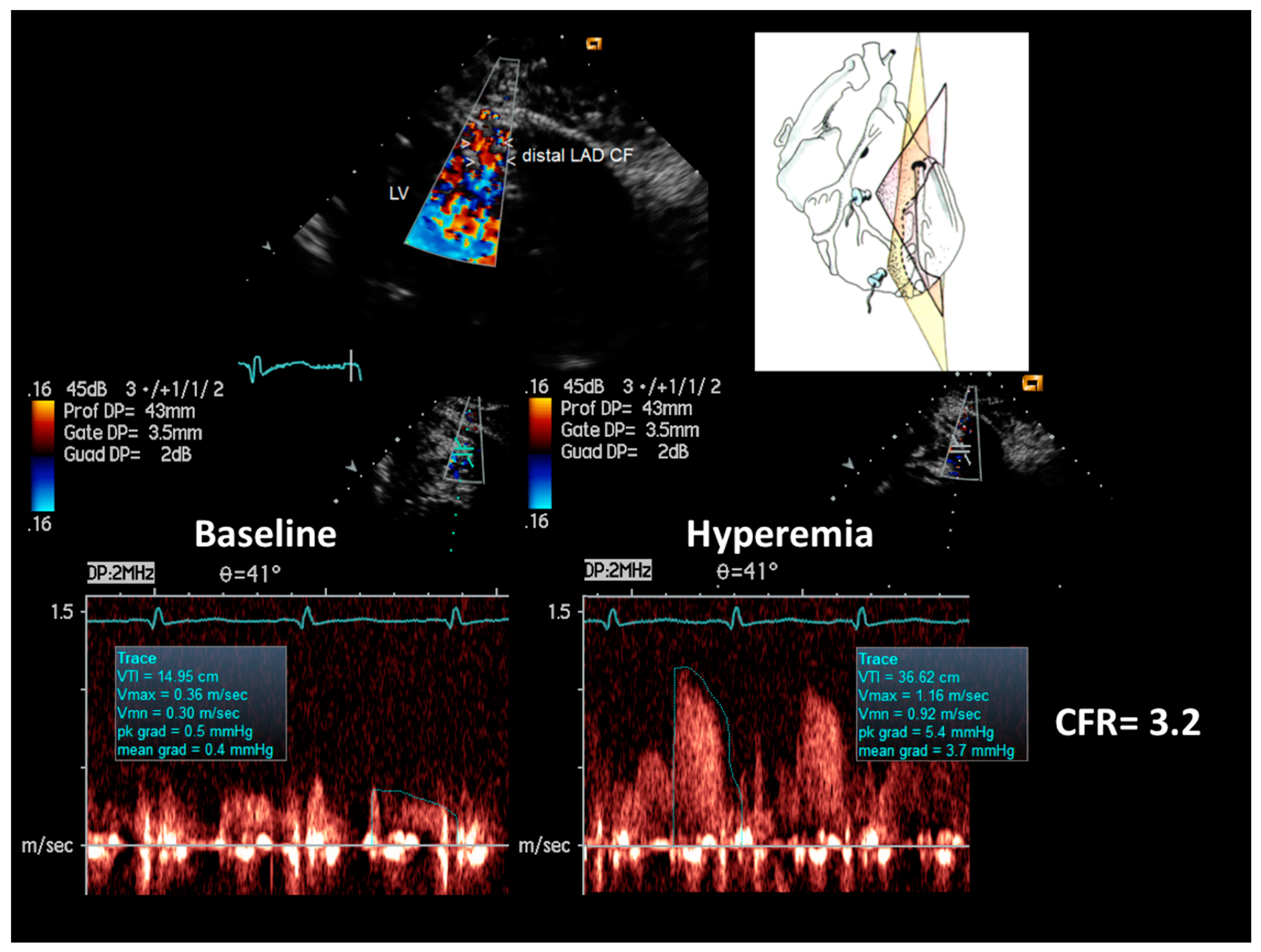 Diagnostics Free Full Text Coronary Flow And Reserve By Enhanced Transthoracic Doppler Trumps Coronary Anatomy By Computed Tomography In Assessing Coronary Artery Stenosis Html Diagnostics Free Full Text Coronary Flow And Reserve By Enhanced Transthoracic Doppler Trumps Coronary Anatomy By Computed Tomography In Assessing Coronary Artery Stenosis Html