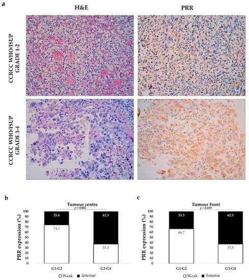 Diagnostics Free Full Text Clinical Implications Of Pro Renin Receptor Prr Expression In Renal Tumours Html