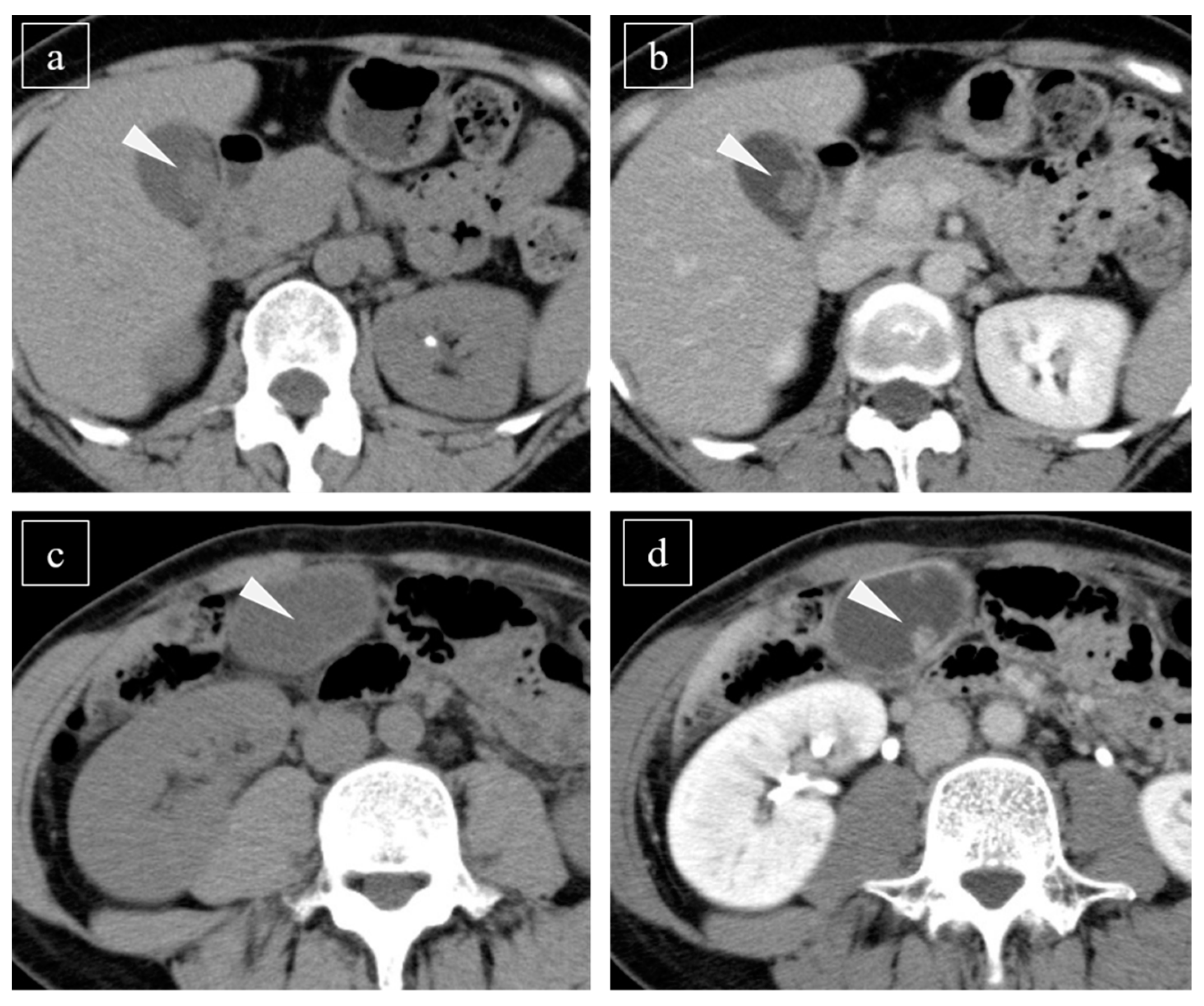 abdominal ct scan with contrast gallbladder