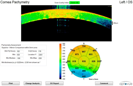 Diagnostics Free Full Text Postmortem Ocular Findings In The Optical Coherence Tomography Era A Proof Of Concept Study Based On Six Forensic Cases Html