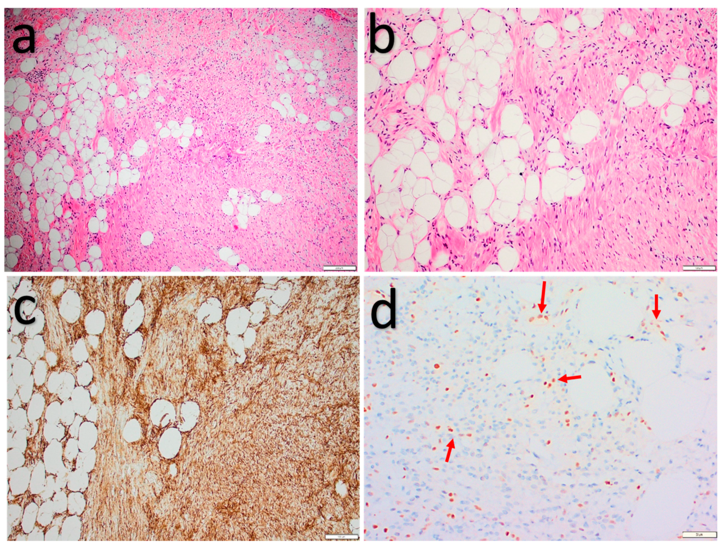 spindle cells and ropey collagen- found in spindle cell lipomas