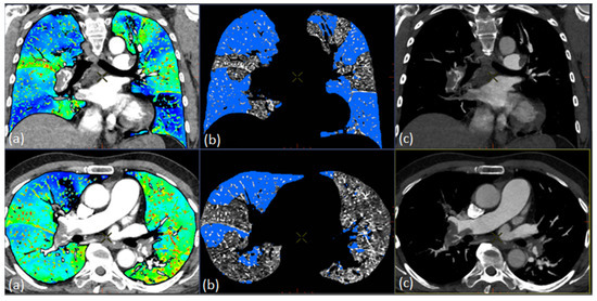 Acute Pulmonary Embolism Severity Assessment Evaluated with Dual Energy ...