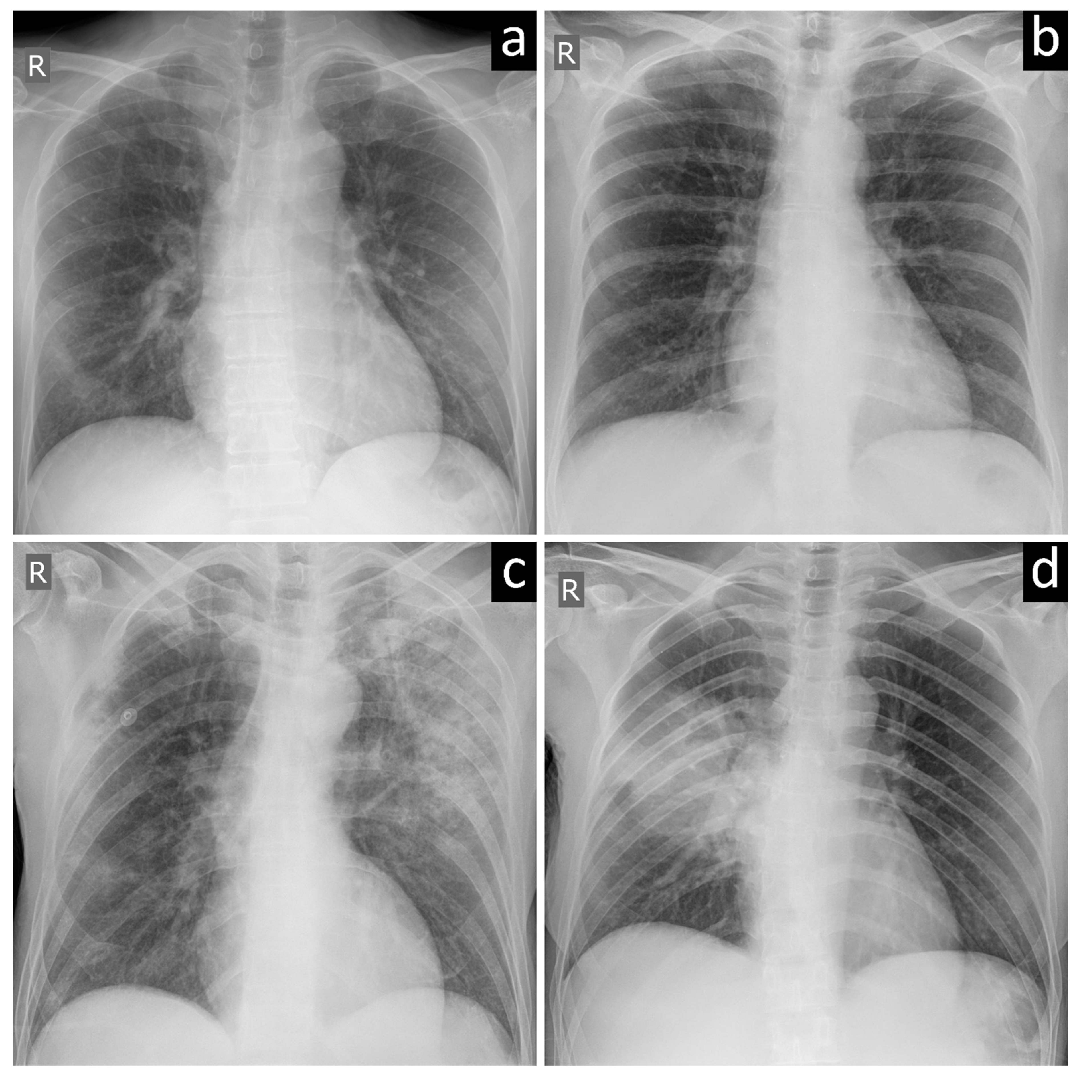 chest x ray pneumonia