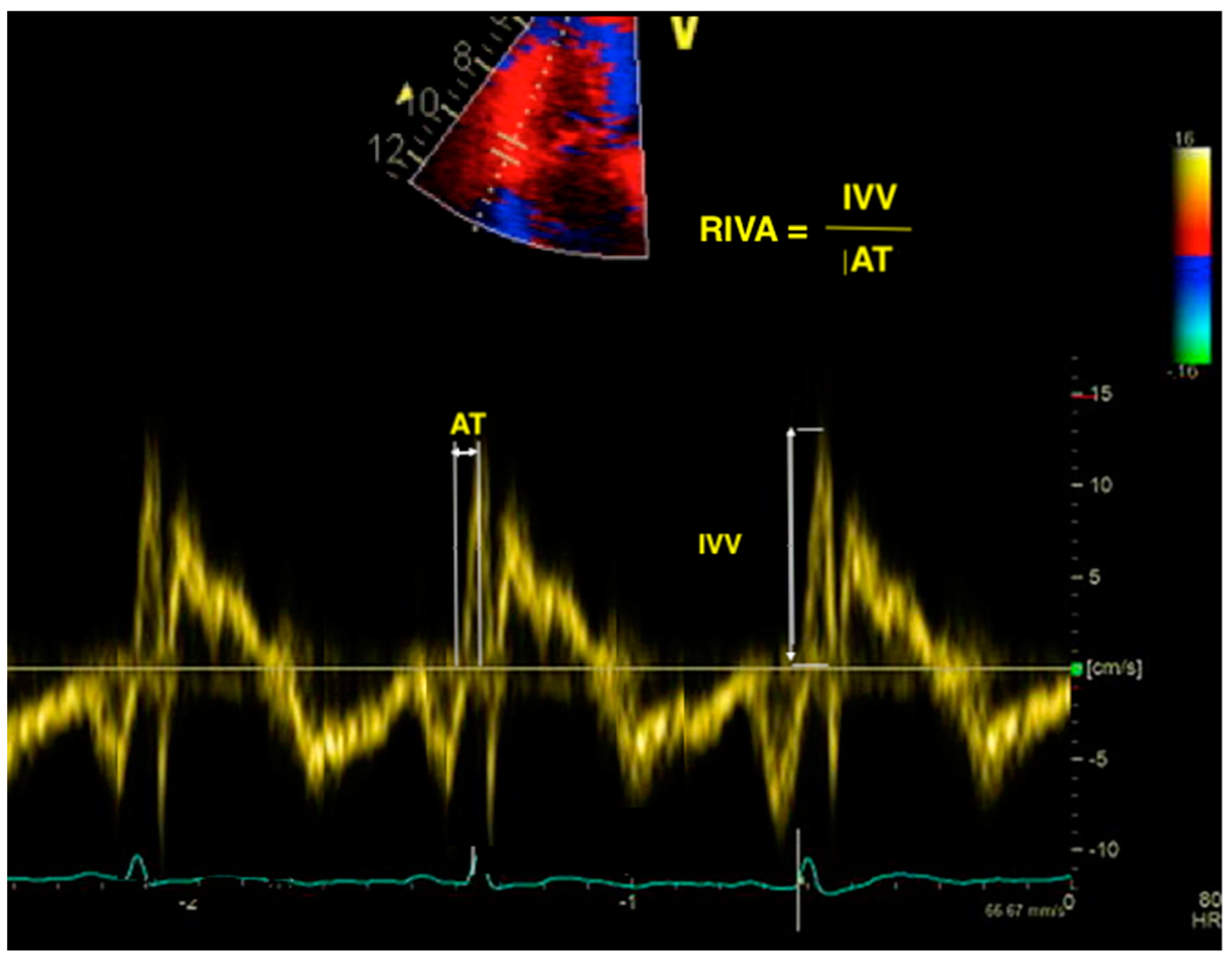 Diagnostics Free FullText No More—The Role of Right Ventricular Dysfunction in