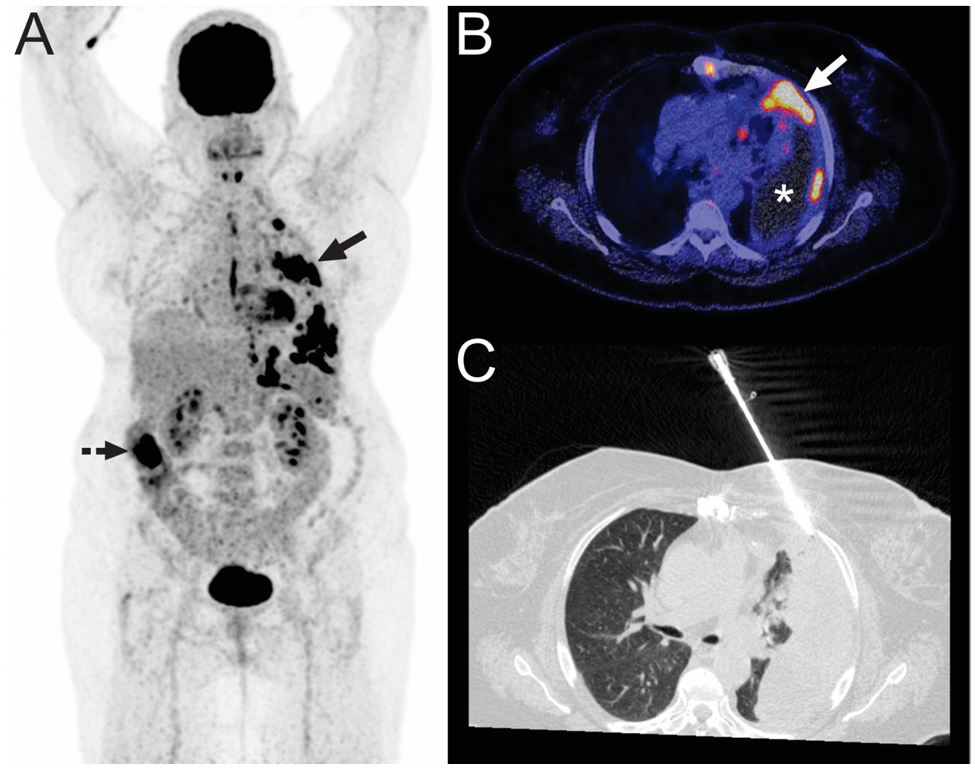 can immunotherapy cause lymph nodes to swell