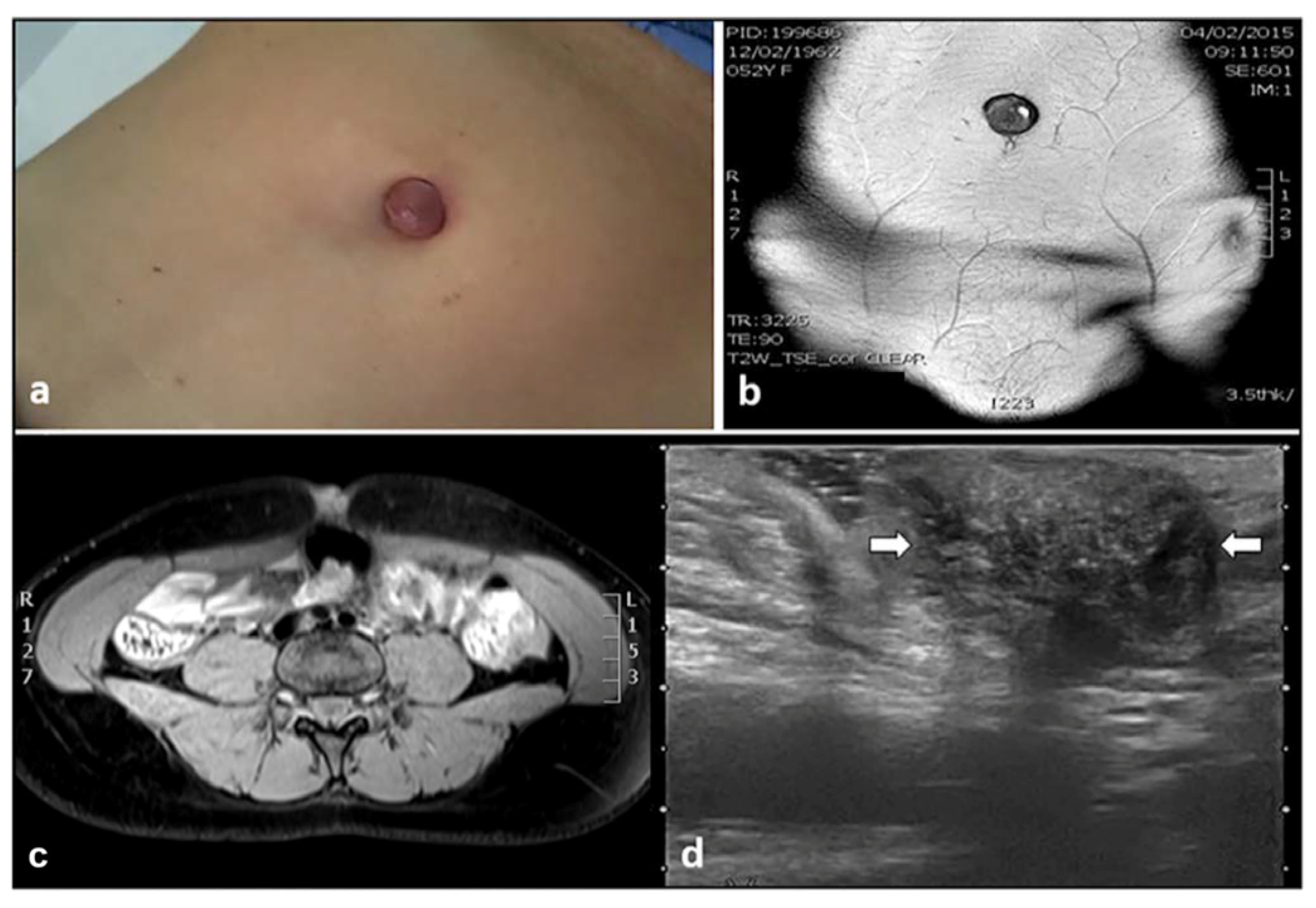 Diagnostics Free Full Text Ultrasound Imaging Of Abdominal Wall