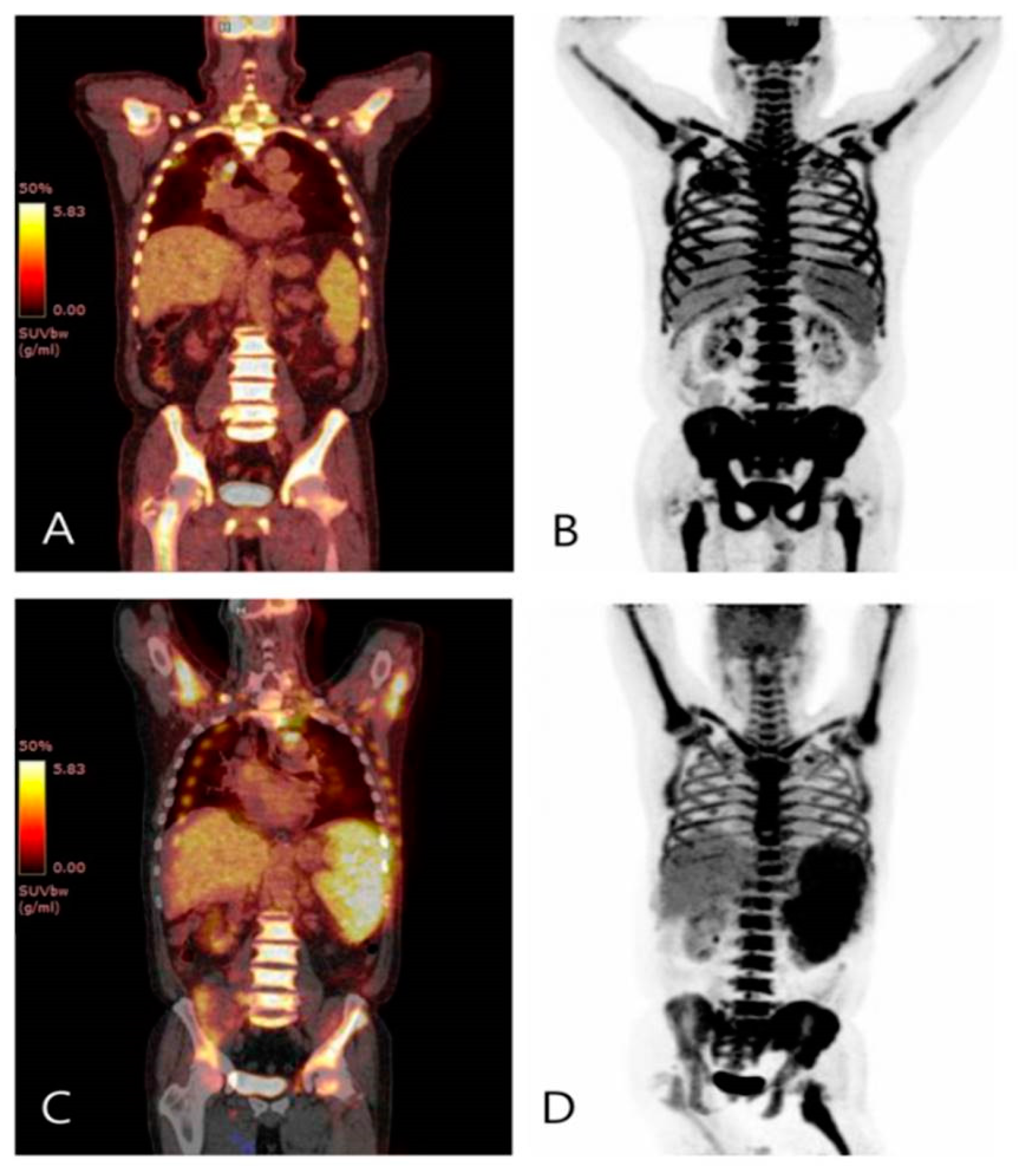 Diagnostics Free FullText A Case of Chronic Neutrophilic Leukemia
