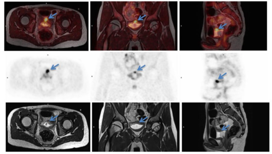 Eosinophilic Cystitis Presenting as Possible Pediatric Rhabdomyosarcoma ...