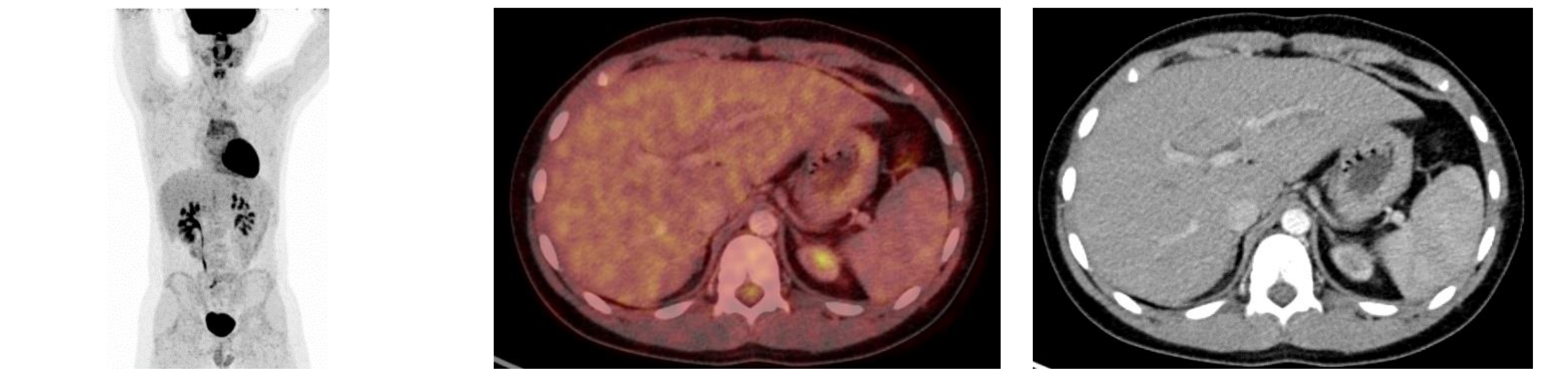 Eosinophilic Cystitis Presenting as Possible Pediatric Rhabdomyosarcoma ...