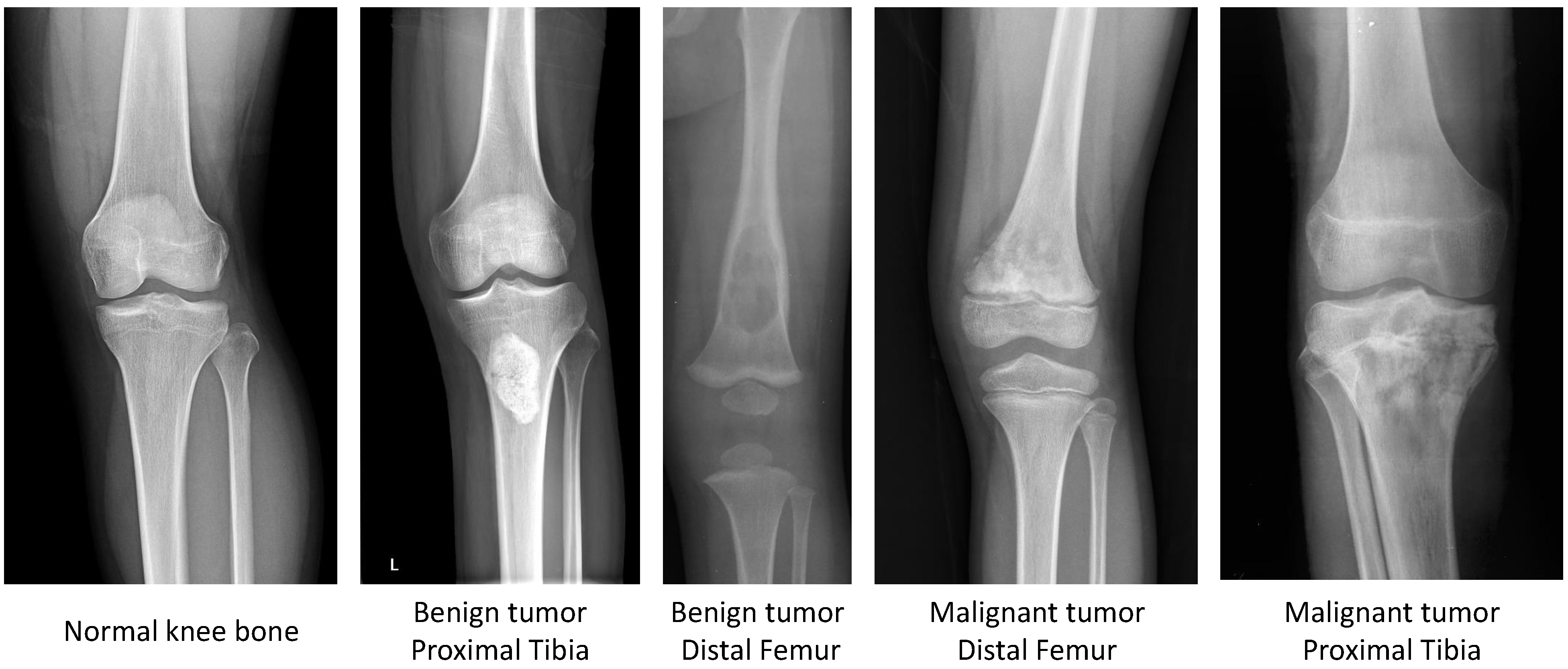 Bone Metastases Images and Xrays