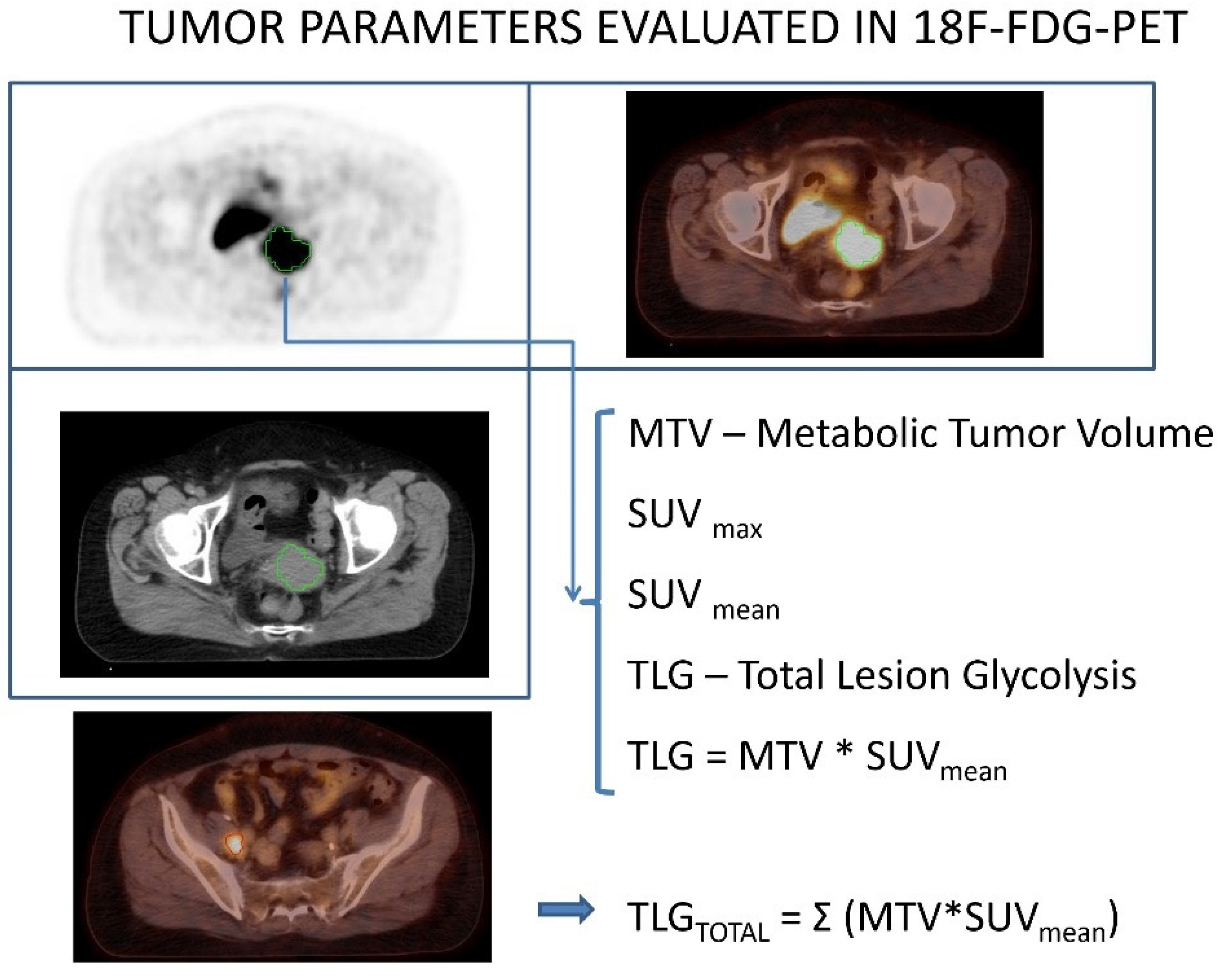 Diagnostics | Free Full-Text | Pretreatment [18F]FDG PET/CT Prognostic Factors in Squamous Cell Cervical Carcinoma FIGO