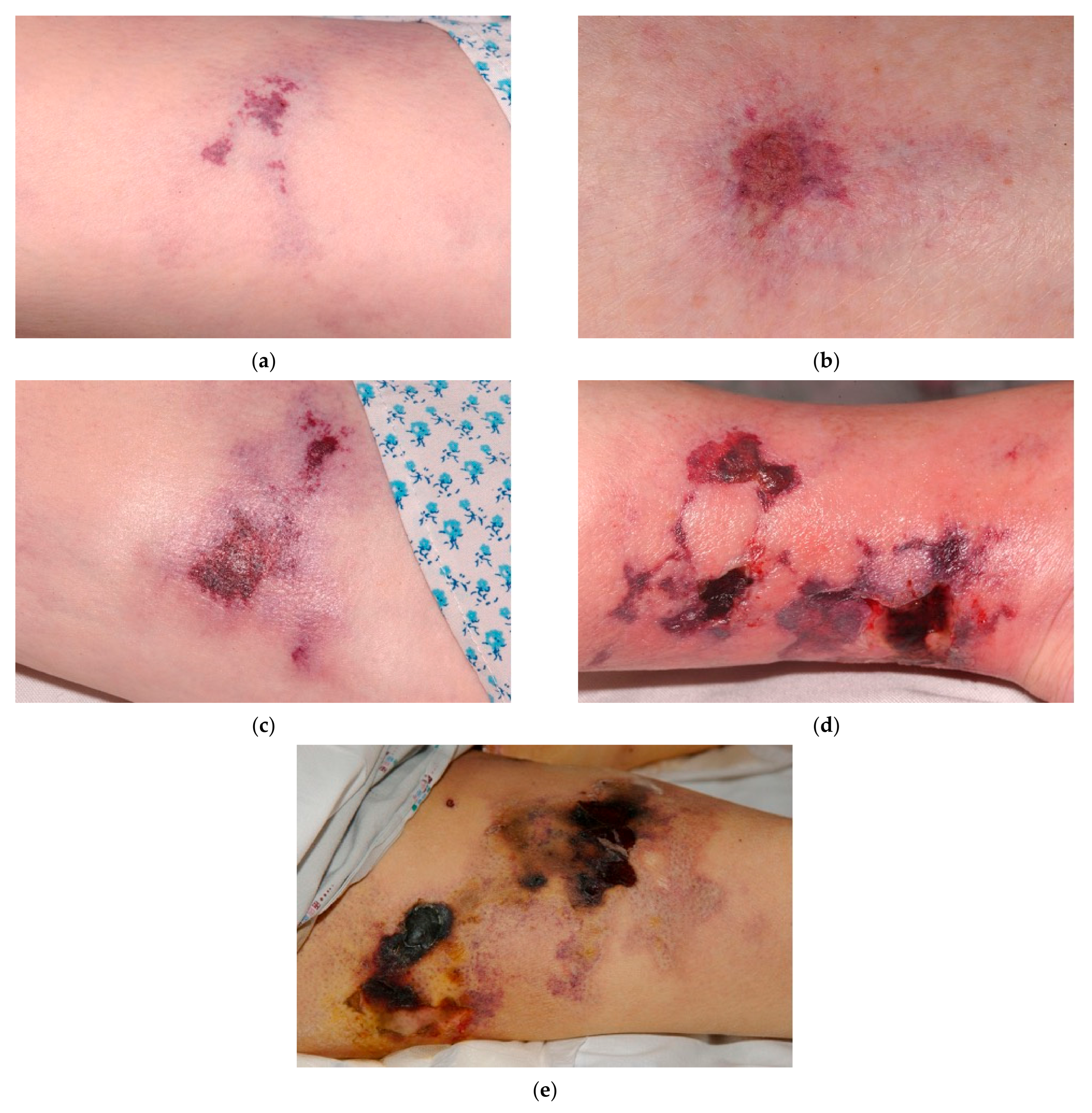 calciphylaxis patient education