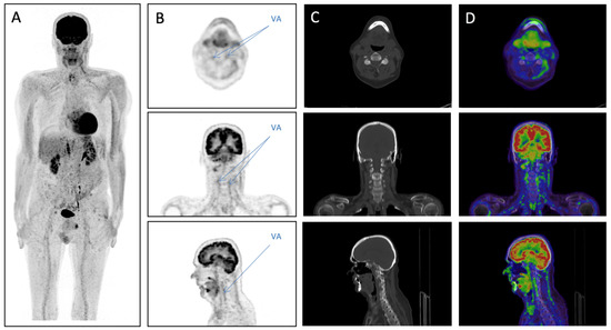 Bilateral Vertebral Artery Vasculitis—A Rare Manifestation of Giant ...