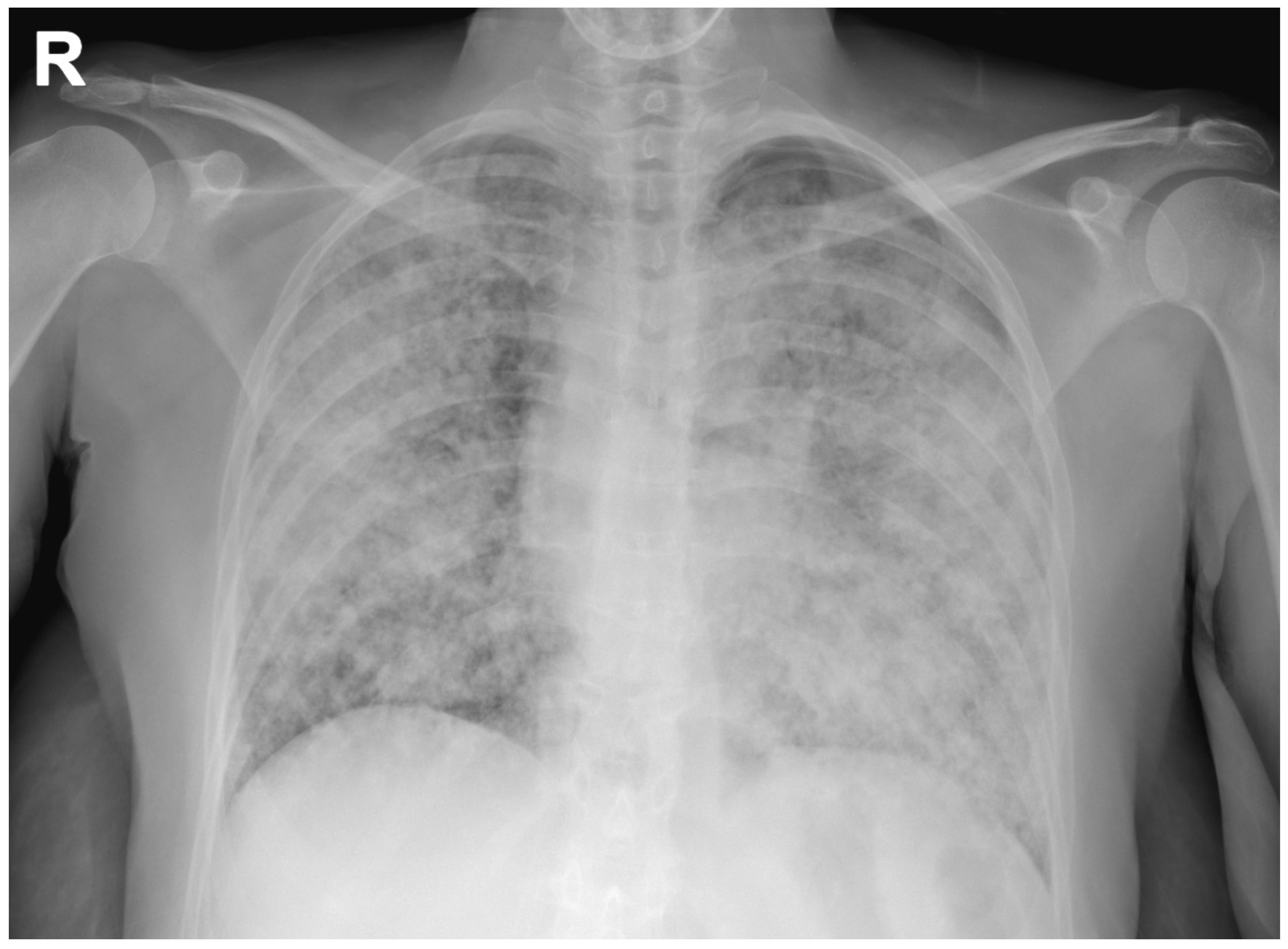 Interstitial Pneumonia X Ray