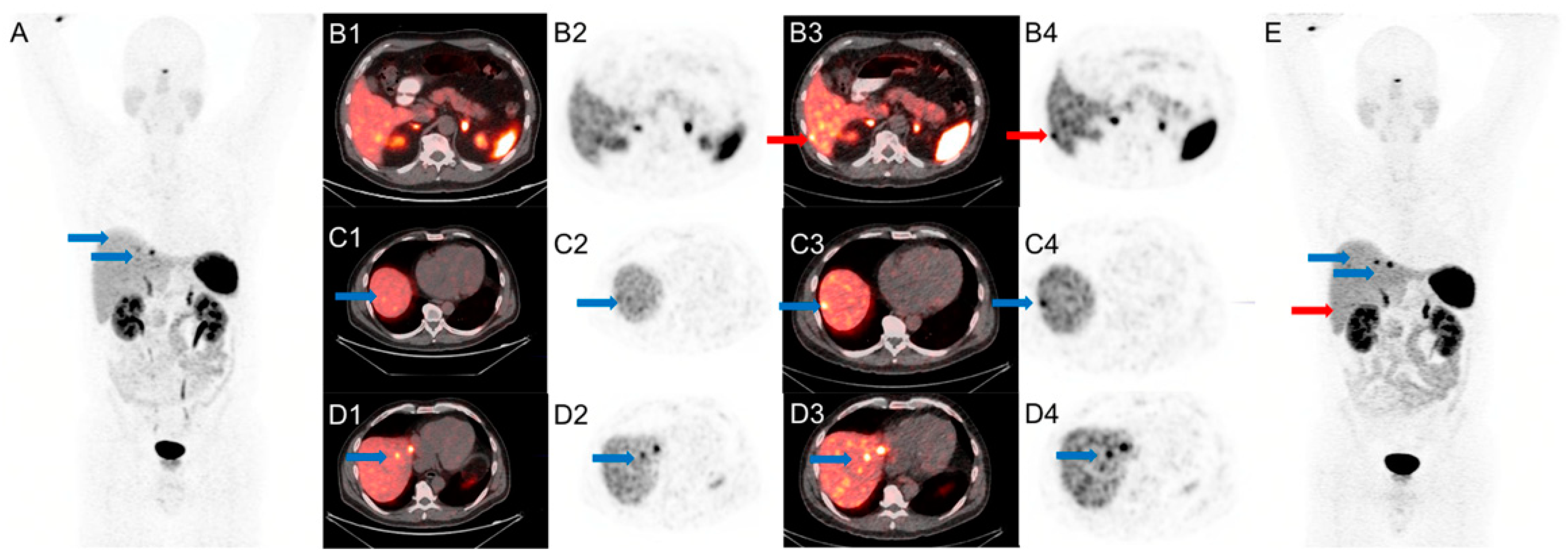 Results of a Prospective Trial to Compare 68Ga-DOTA-TATE with SiPM ...