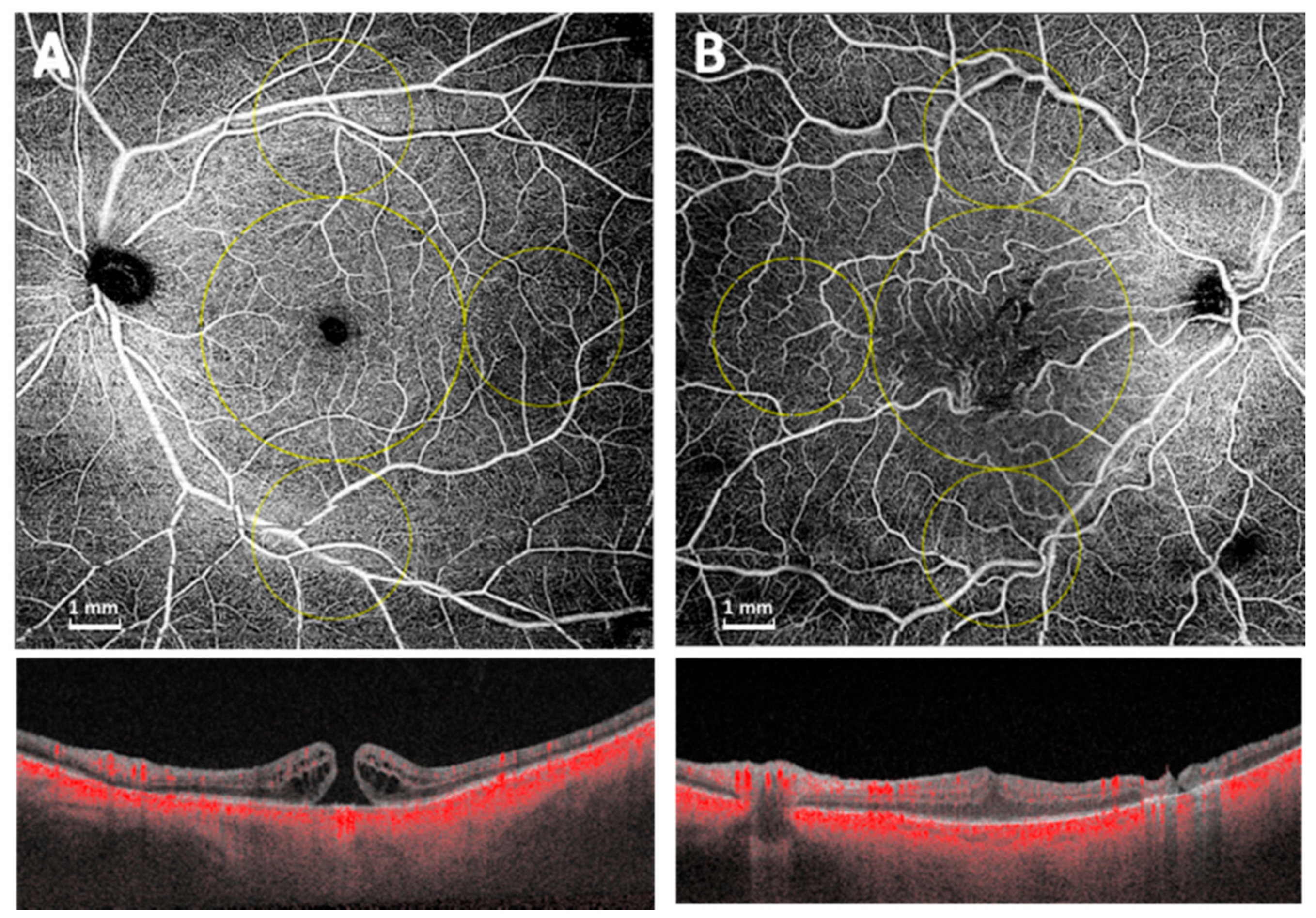 Diagnostics Free Full Text Early Vascular And Functional Changes After Vitreoretinal Surgery A Comparison Between The Macular Hole And Epiretinal Membrane Html Diagnostics Free Full Text Early Vascular And Functional Changes After Vitreoretinal Surgery A Comparison Between The Macular Hole And Epiretinal Membrane Html