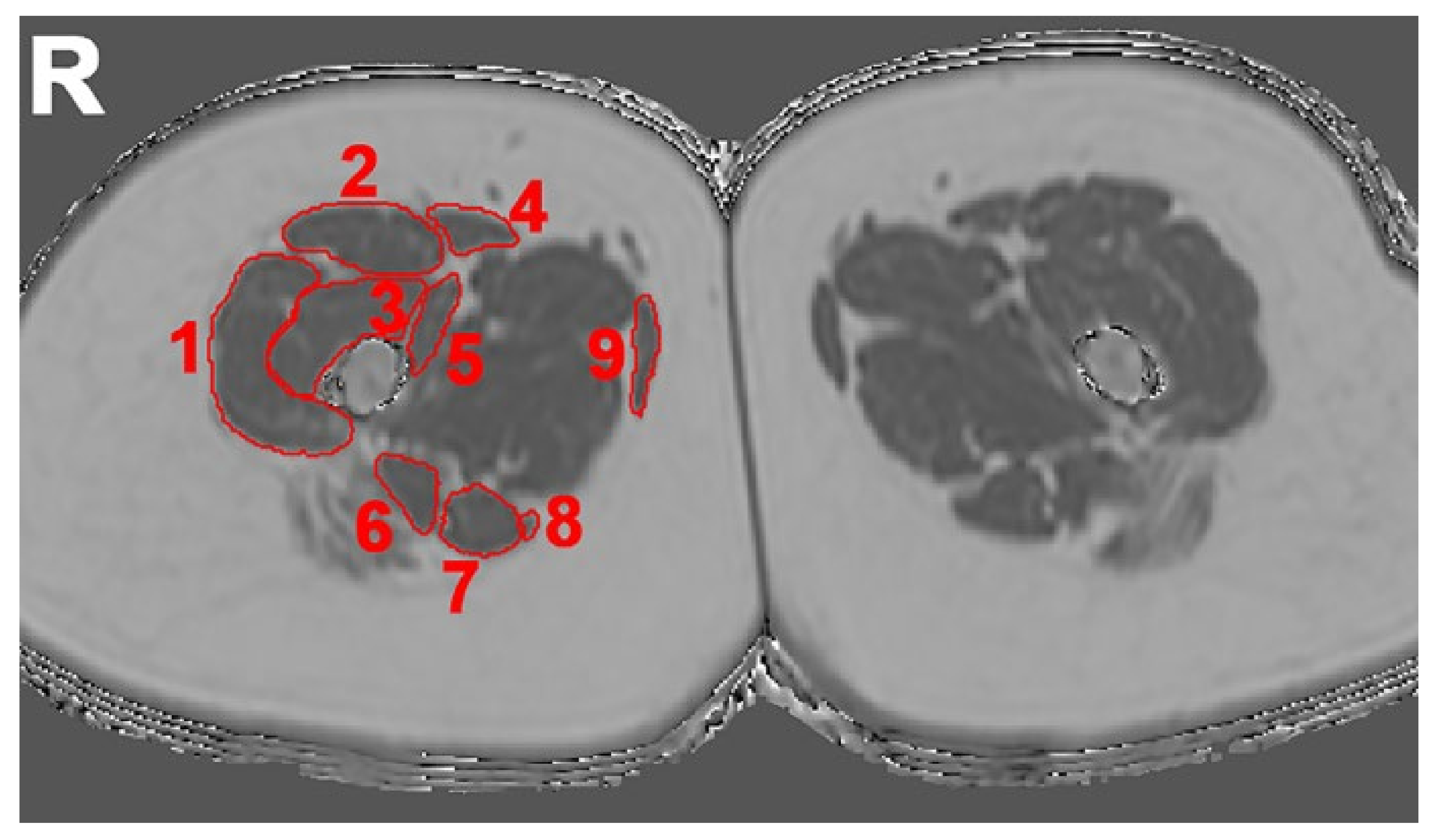 Diagnostics | Free Full-Text | Quantitative Muscle MRI in Patients with Neuromuscular Diseases—Association of Muscle Proton Density Fat Fraction with Semi-Quantitative Grading of Fatty Infiltration and Muscle Strength at the Region