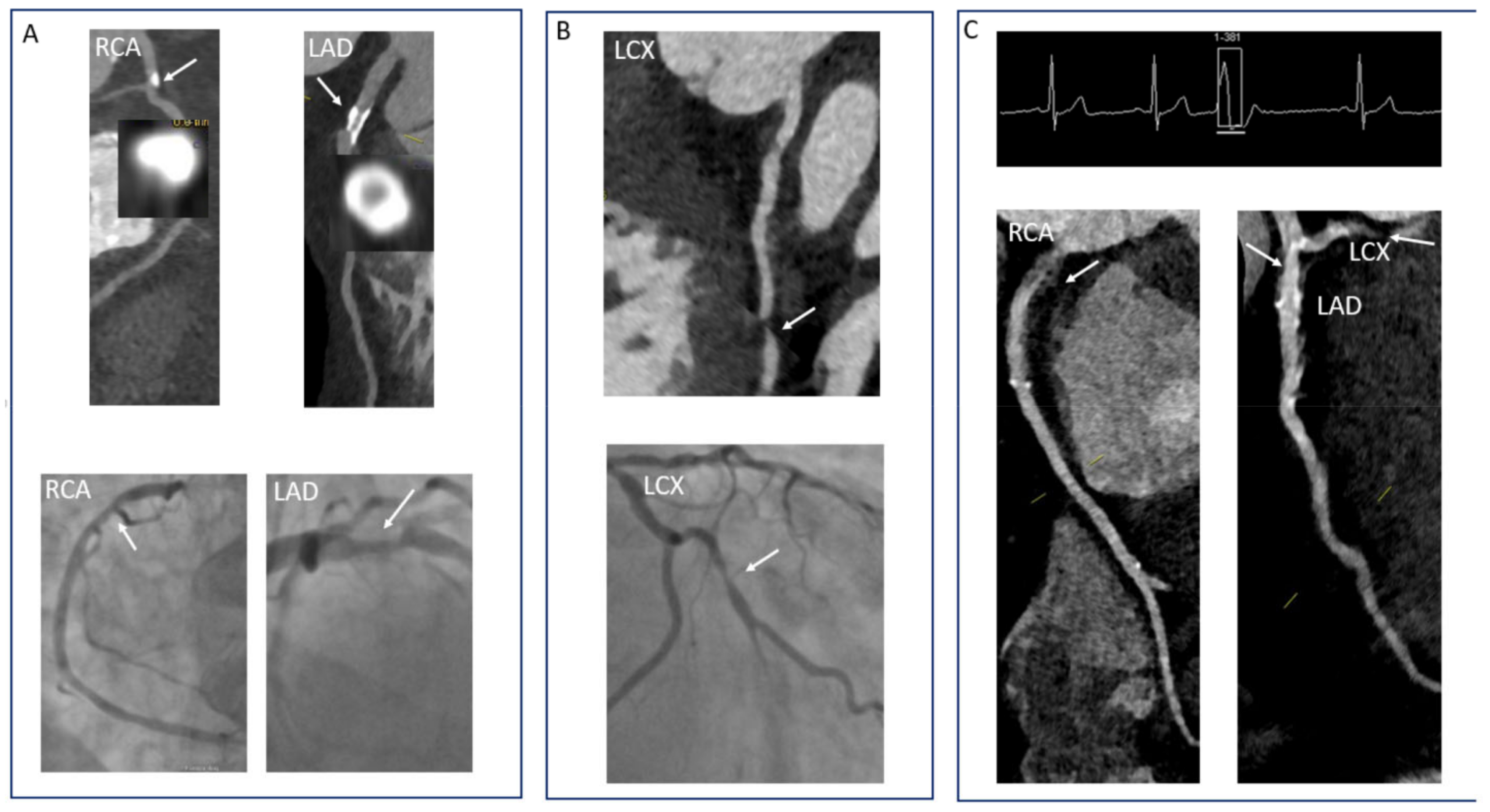 | Free Full-Text | Coronary Computer Tomography in 2021—Acquisition Protocols, Tips Tricks and Heading beyond Possible