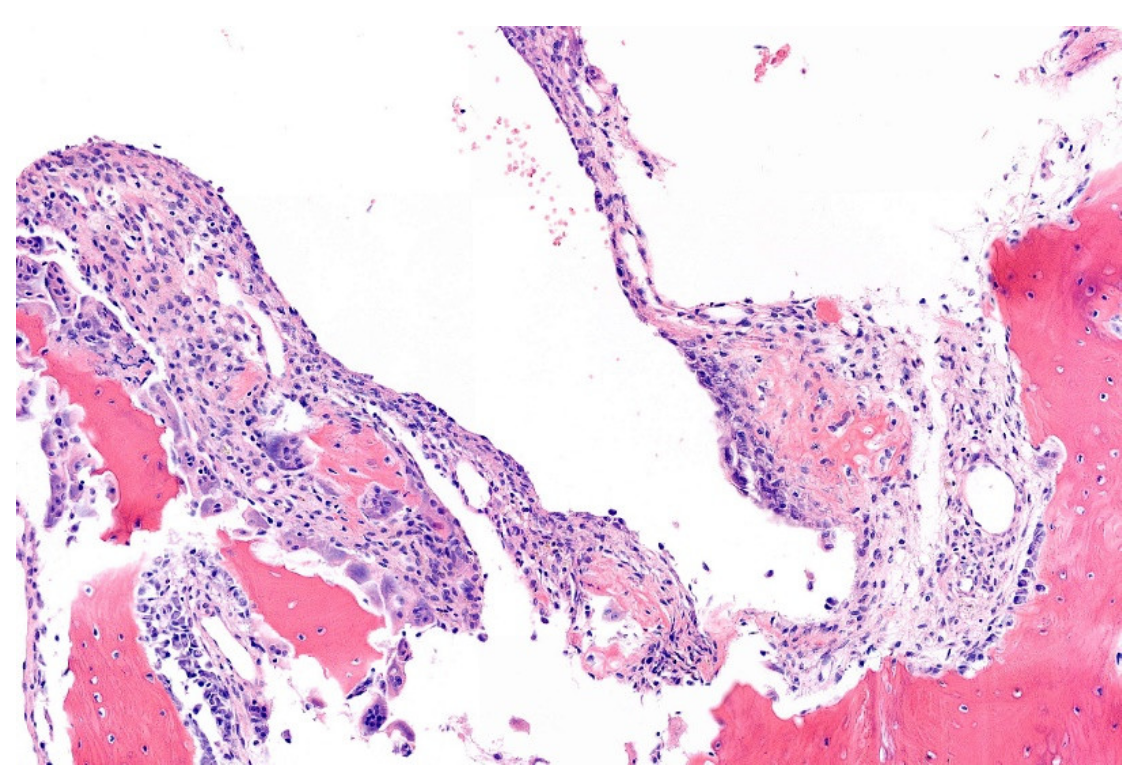 mesothelioma ct scan images