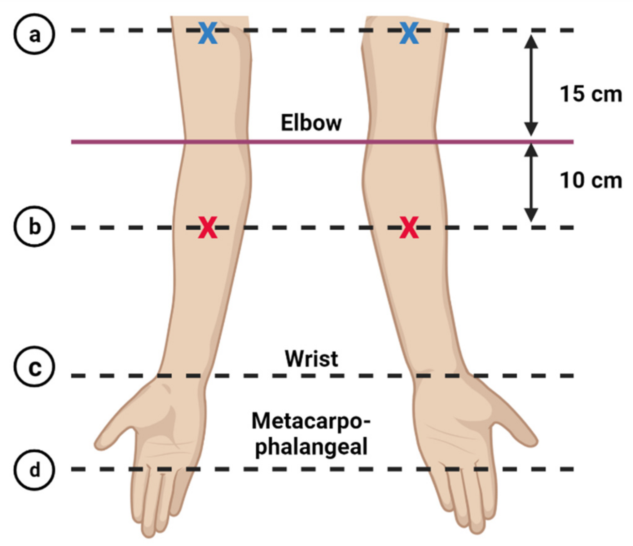 Diagnostics Free Full Text Assessment Of Potential Risk Factors And Skin Ultrasound Presentation Associated With Breast Cancer Related Lymphedema In Long Term Breast Cancer Survivors Html Diagnostics Free Full Text Assessment Of Potential Risk Factors And Skin Ultrasound Presentation Associated With Breast Cancer Related Lymphedema In Long Term Breast Cancer Survivors Html