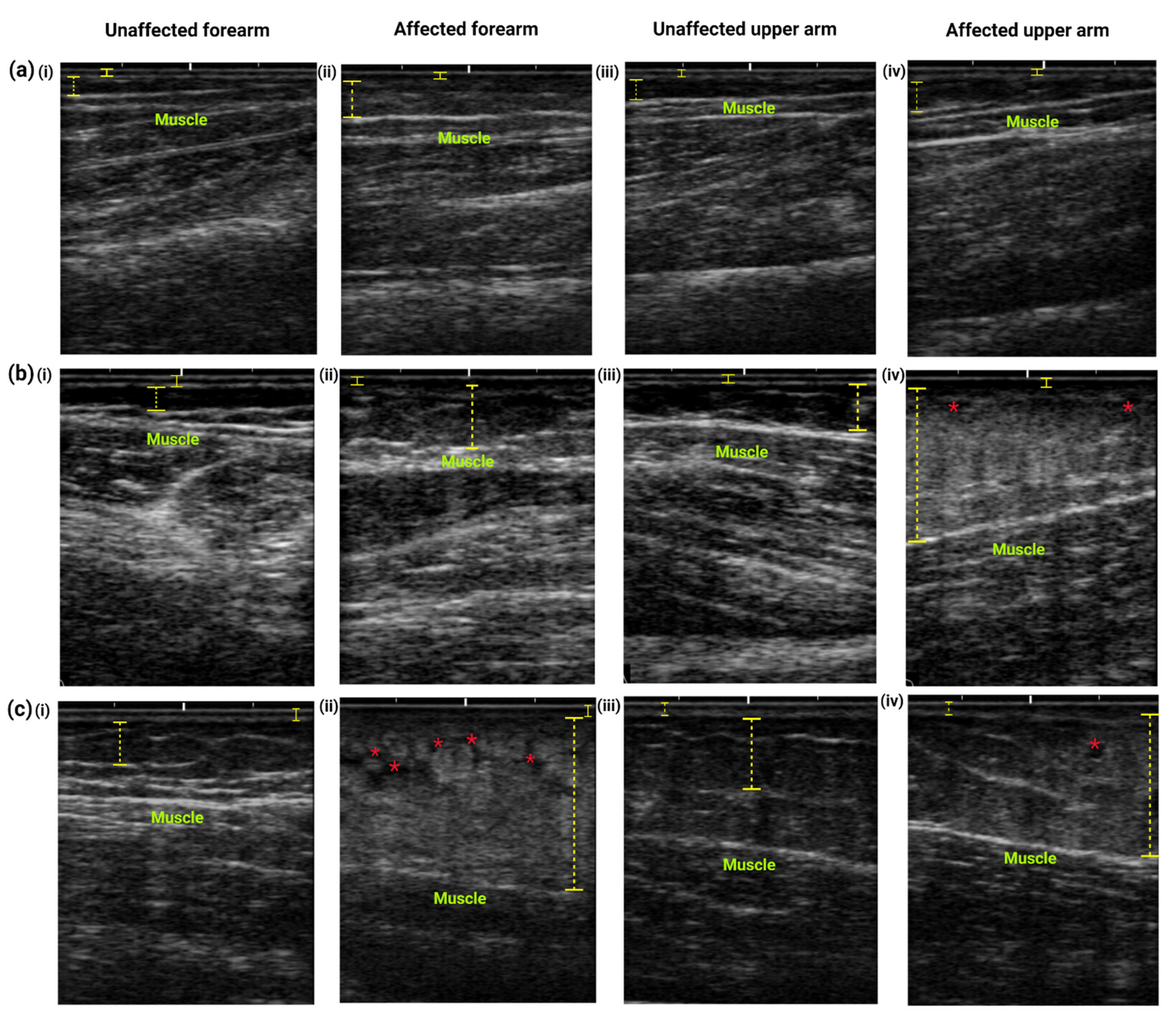 Diagnostics Free Full Text Assessment Of Potential Risk Factors And Skin Ultrasound Presentation Associated With Breast Cancer Related Lymphedema In Long Term Breast Cancer Survivors Html Diagnostics Free Full Text Assessment Of Potential Risk Factors And Skin Ultrasound Presentation Associated With Breast Cancer Related Lymphedema In Long Term Breast Cancer Survivors Html