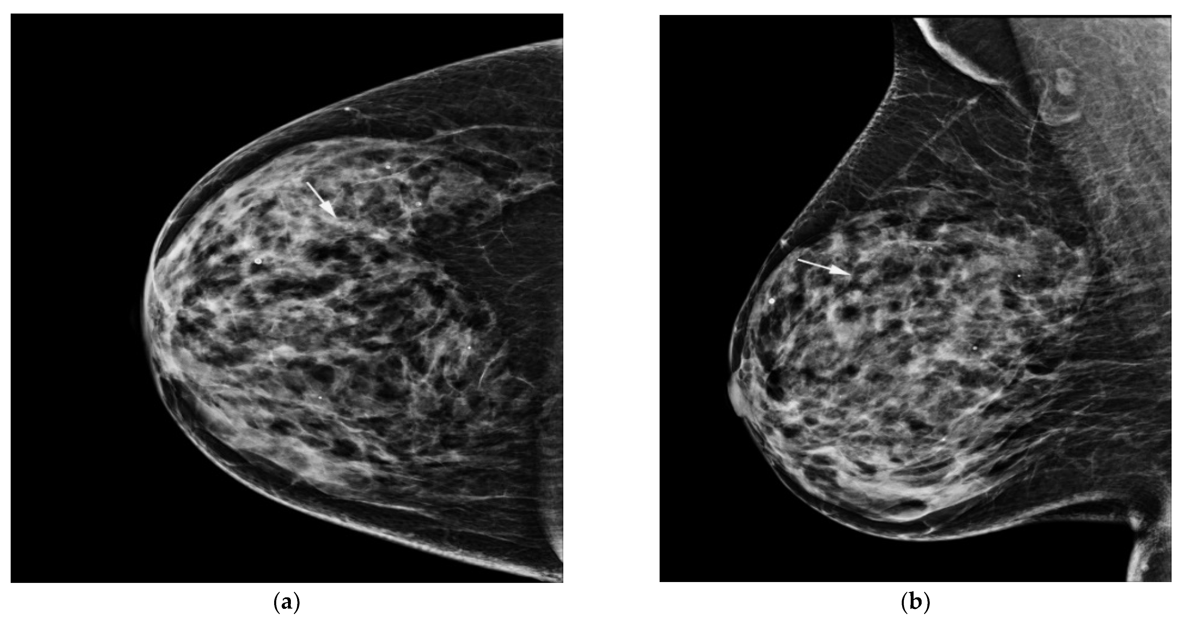 Mammographic microcalcifications and risk of breast cancer