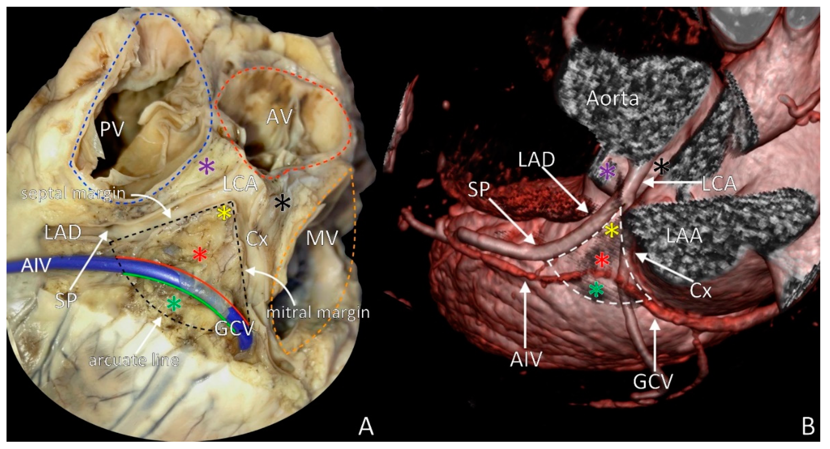 High Resolution Mapping of the Coronary Sinus to Determine Target Site for  Ablation in a Patient with VT Originating from the LV Summit
