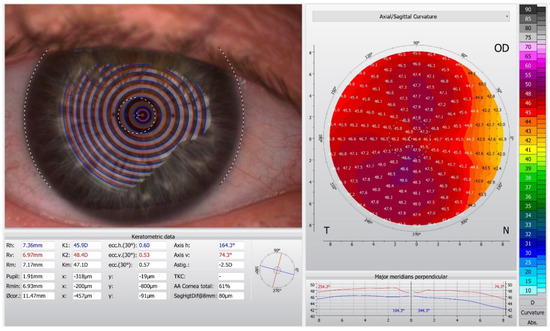 itrace posterior corneal aberrations itrace posterior corneal aberrations