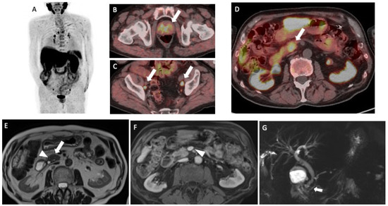 diagnostic aleglandei prostatei