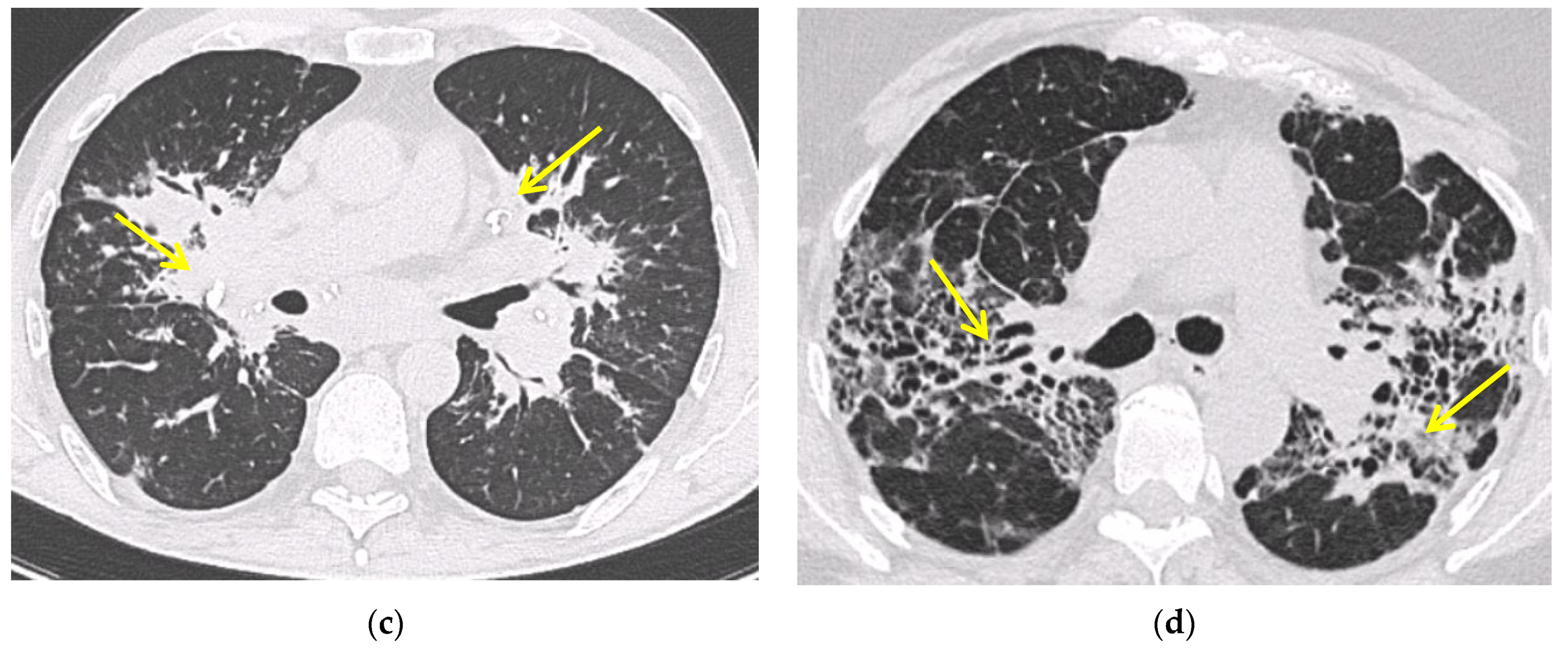 que causa embolia pulmonar